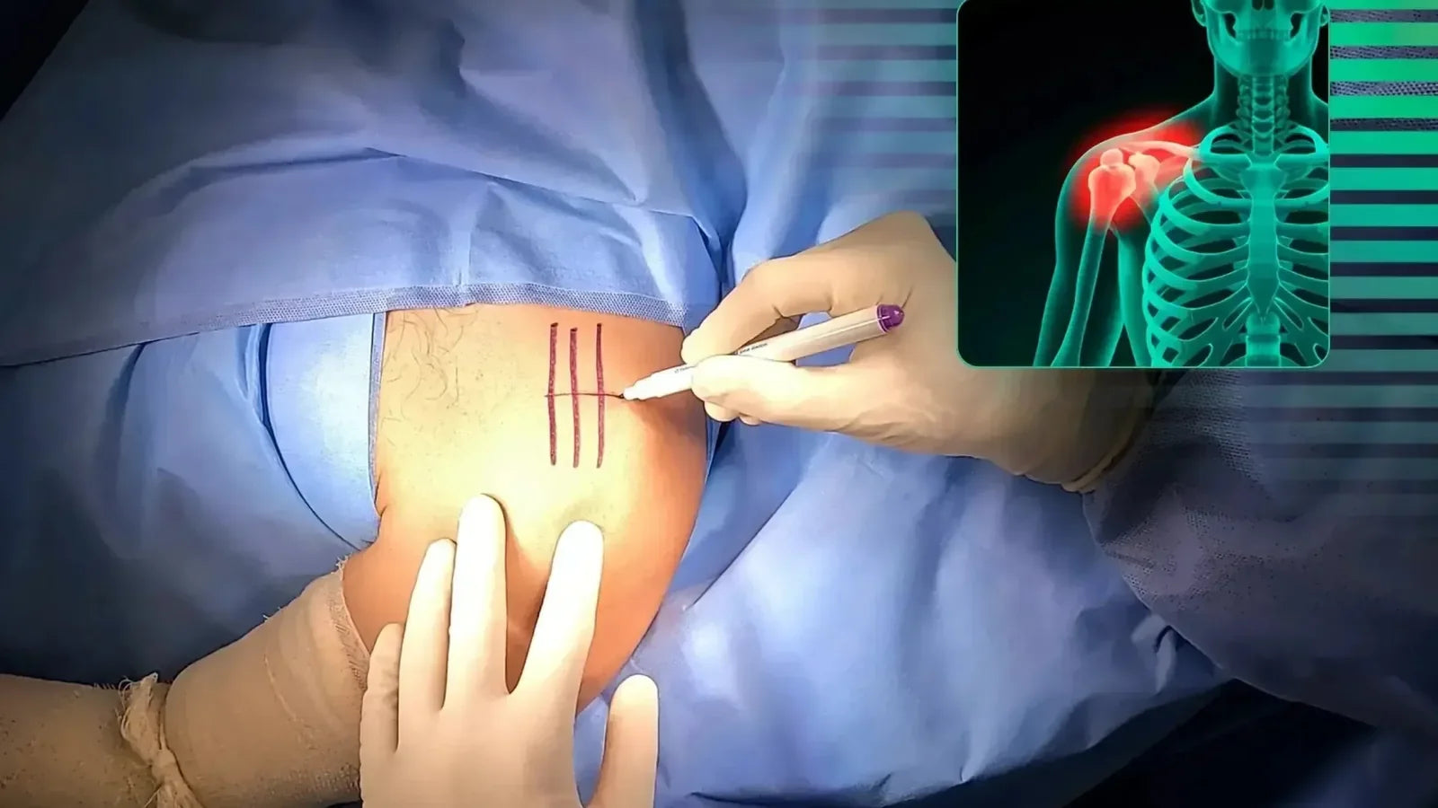 Surgeon marking the operative site before an acromioclavicular joint procedure with an anatomical illustration overlay.