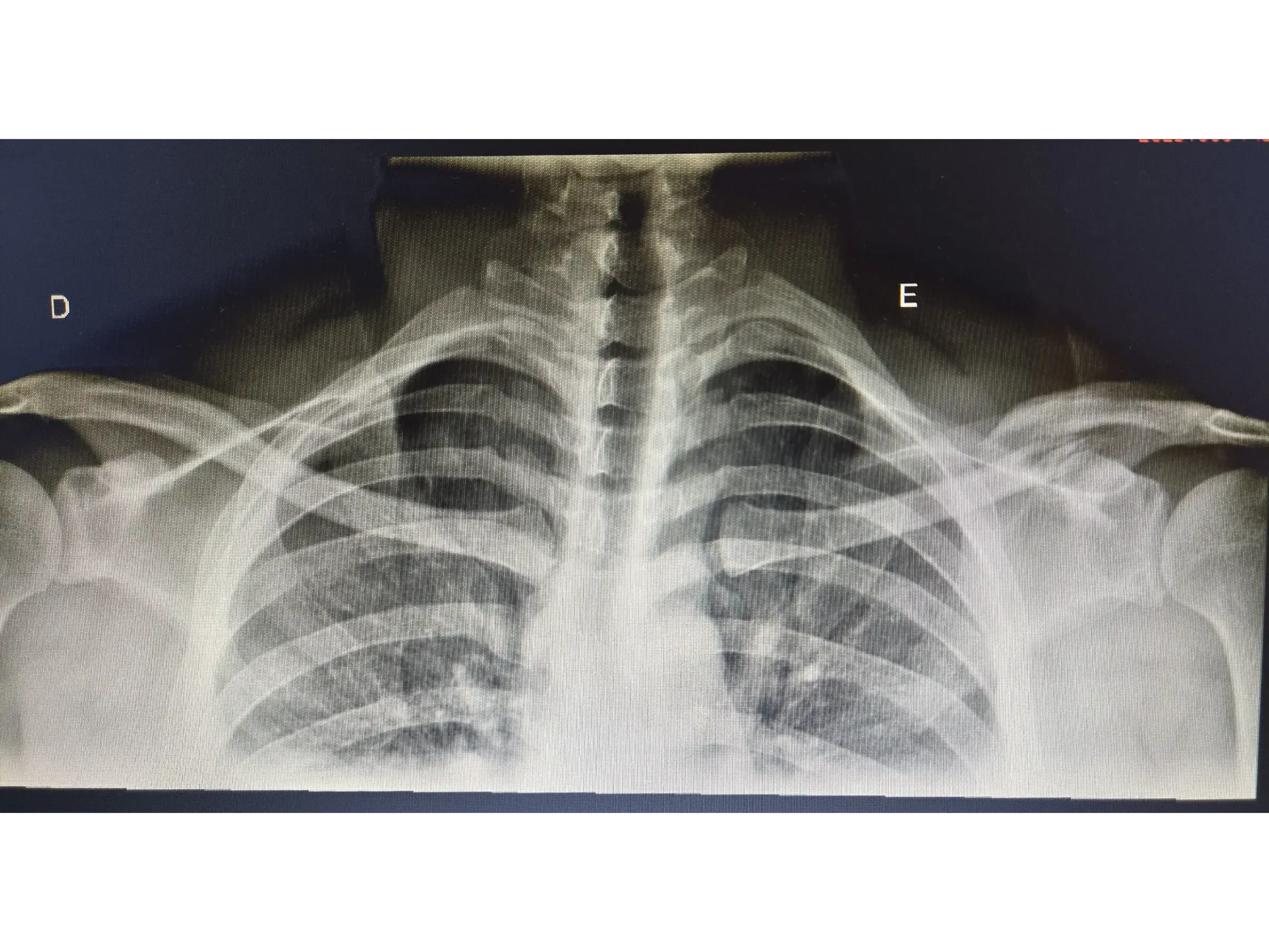 Clavicle Fracture 02 – Minimally Invasive Technique