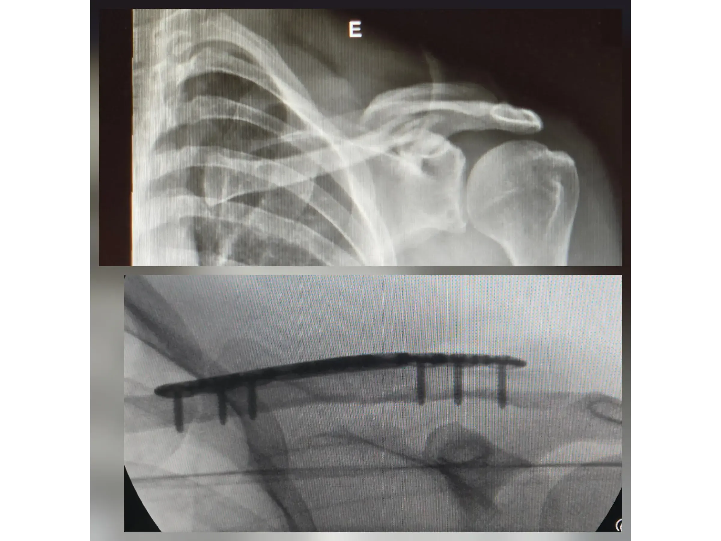 Clavicle Fracture 02 – Minimally Invasive Technique