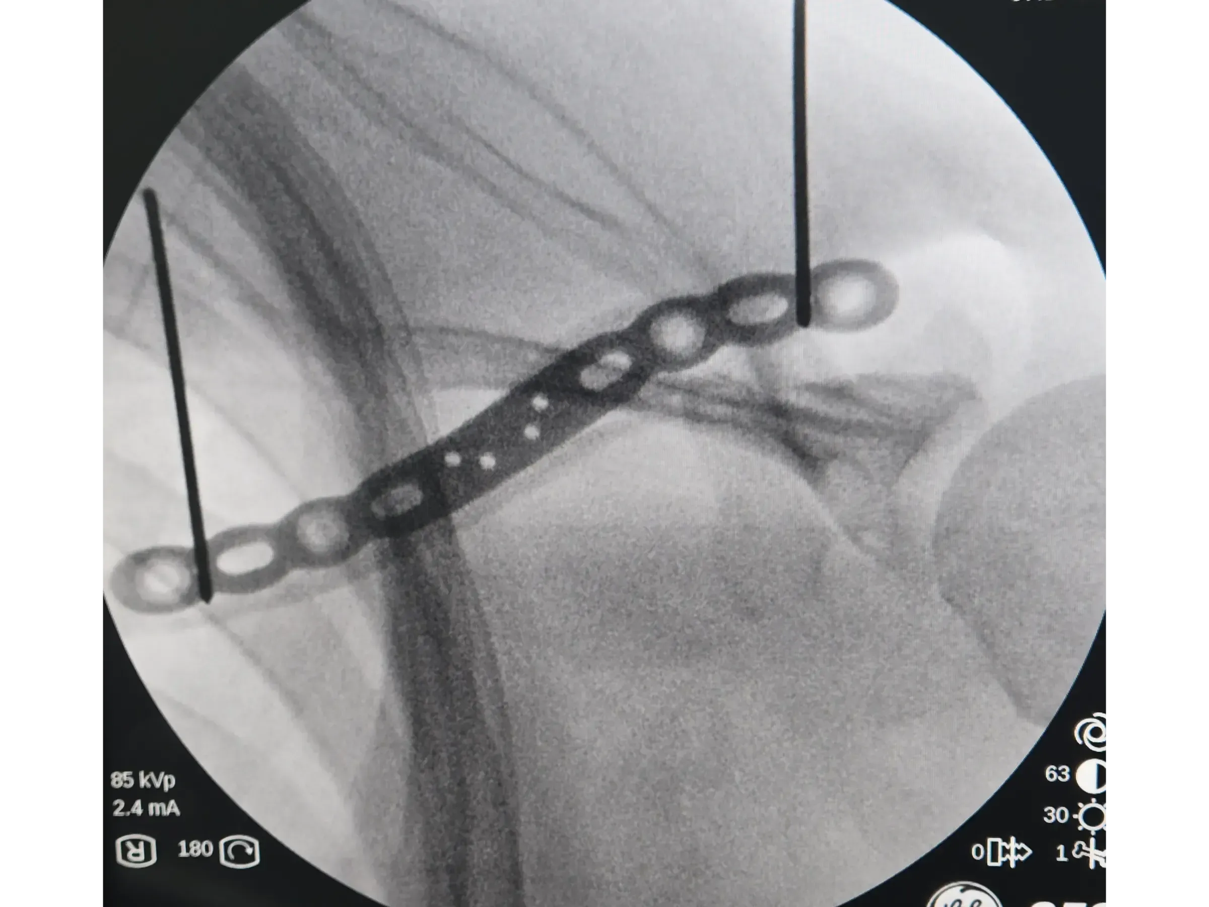 Clavicle Fracture 02 – Minimally Invasive Technique