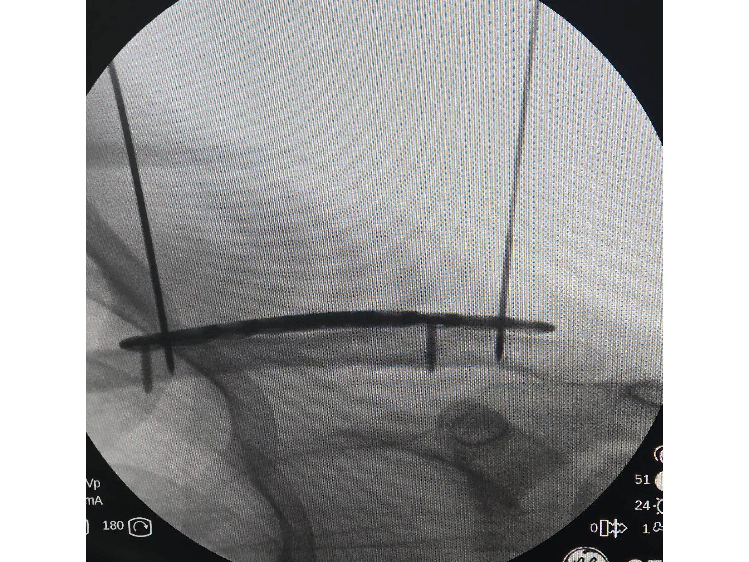 Clavicle Fracture 02 – Minimally Invasive Technique