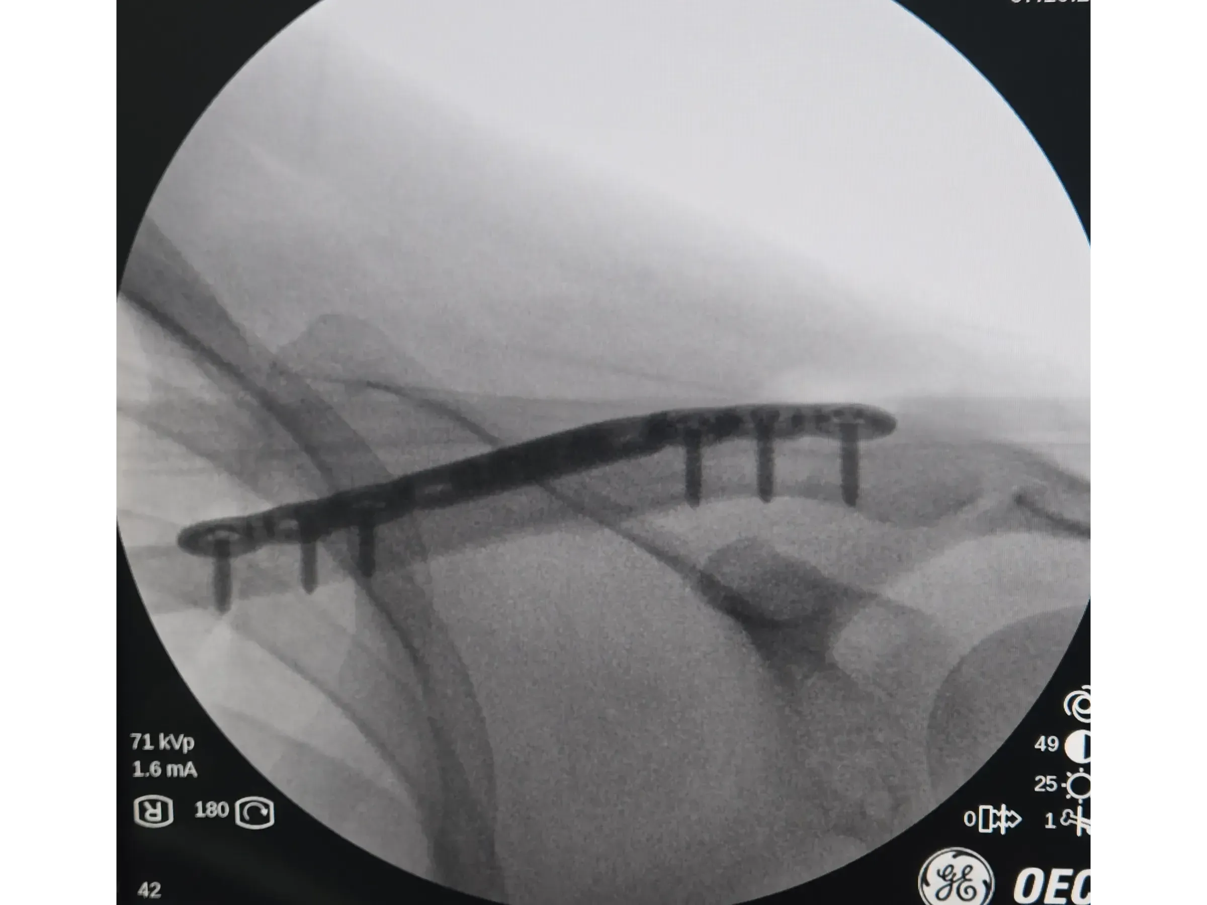 Clavicle Fracture 02 – Minimally Invasive Technique