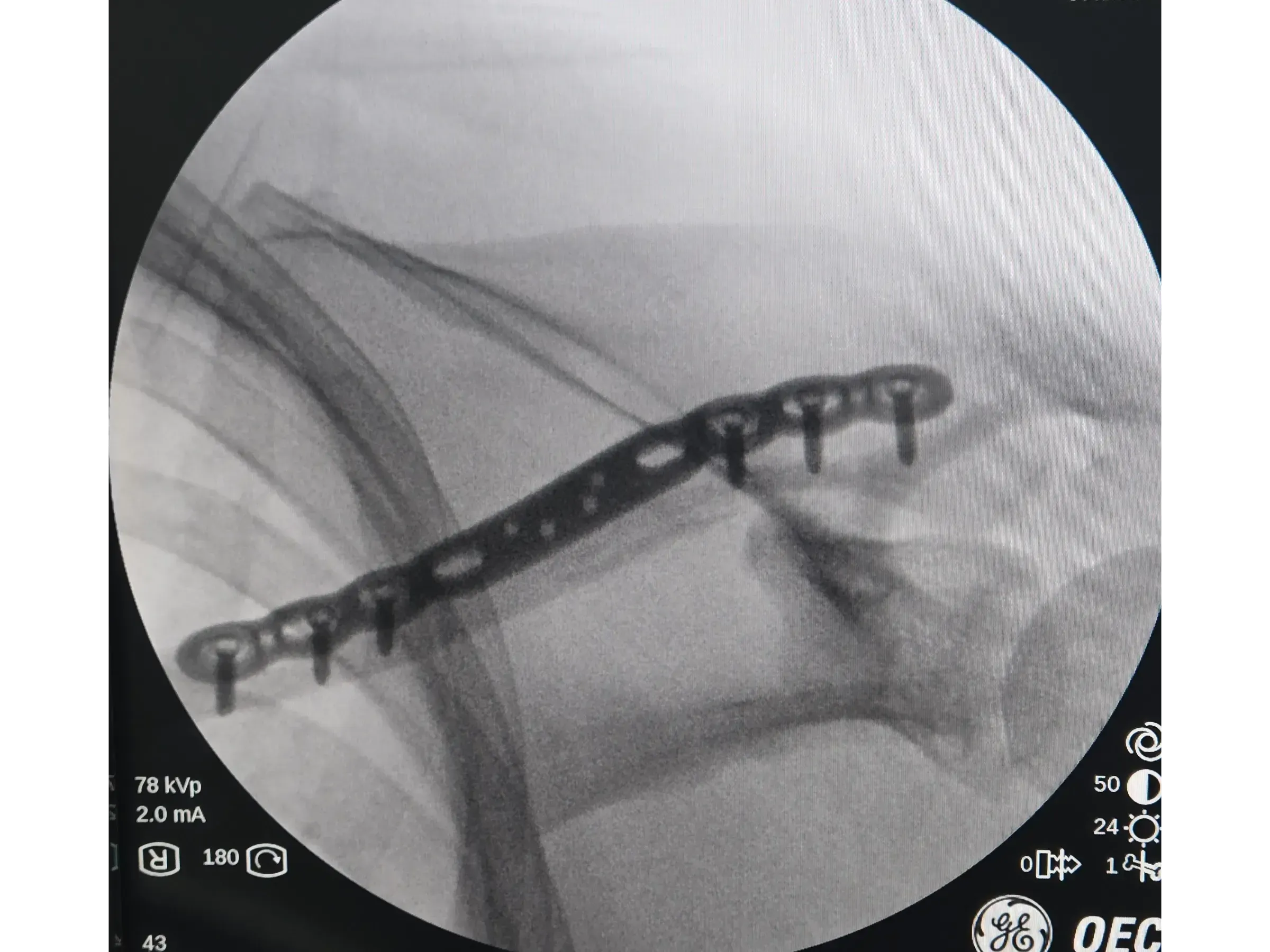 Clavicle Fracture 02 – Minimally Invasive Technique