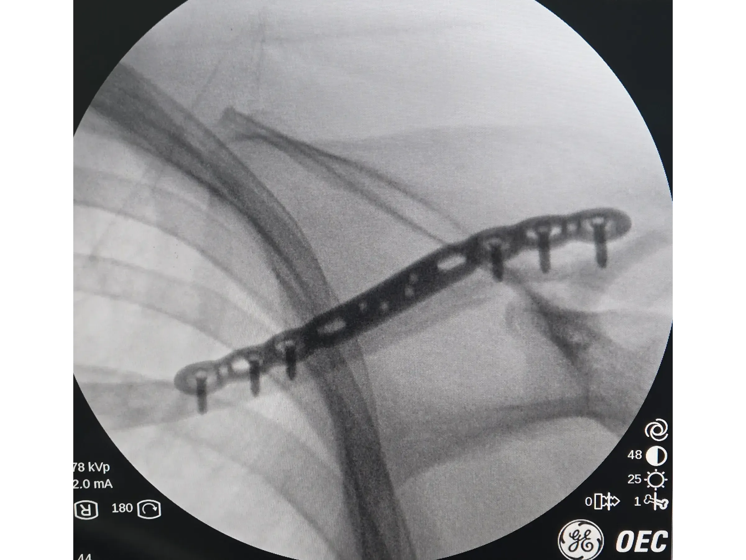 Clavicle Fracture 02 – Minimally Invasive Technique
