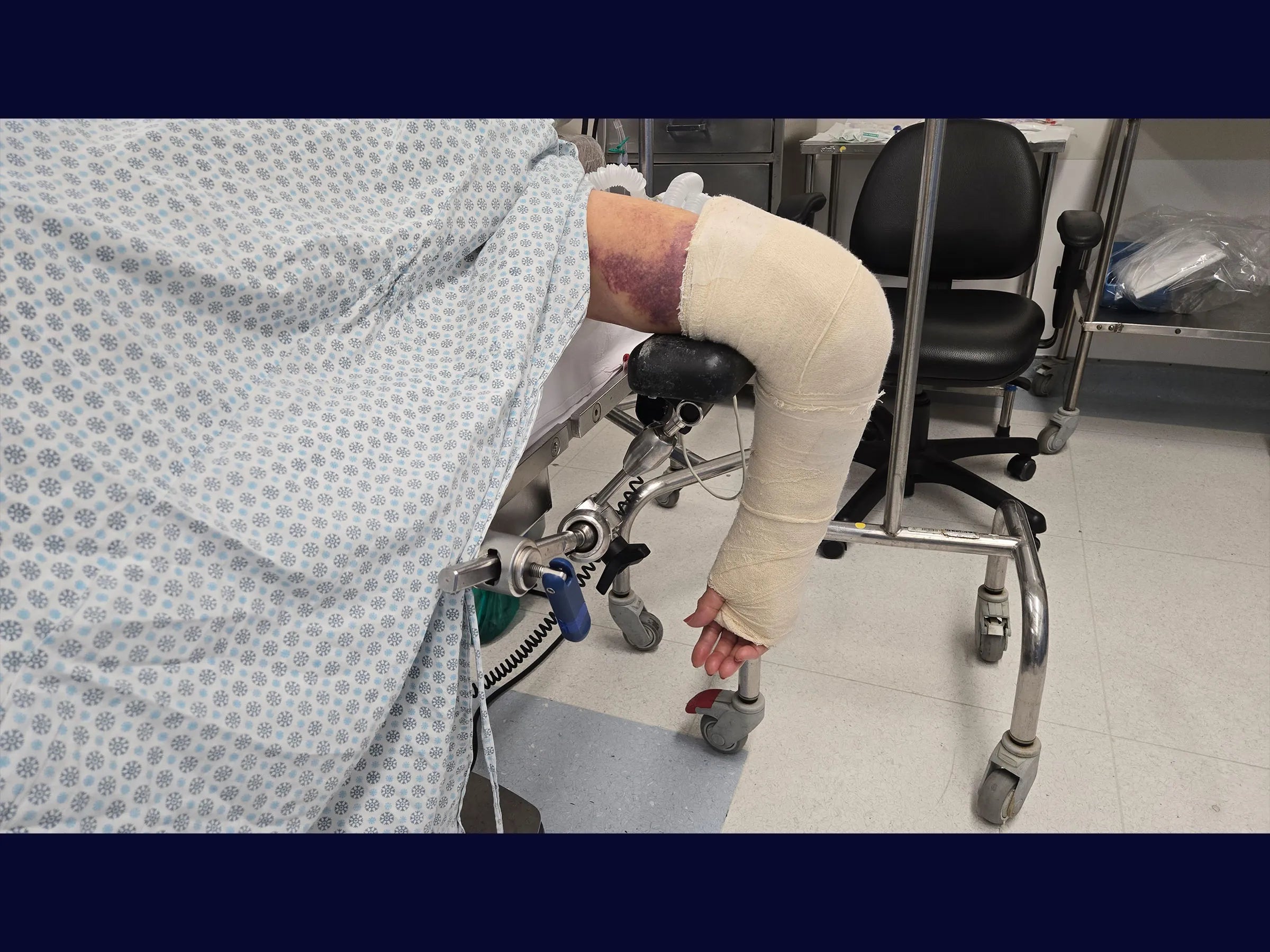 Comminuted Articular Fracture of the Distal Humerus