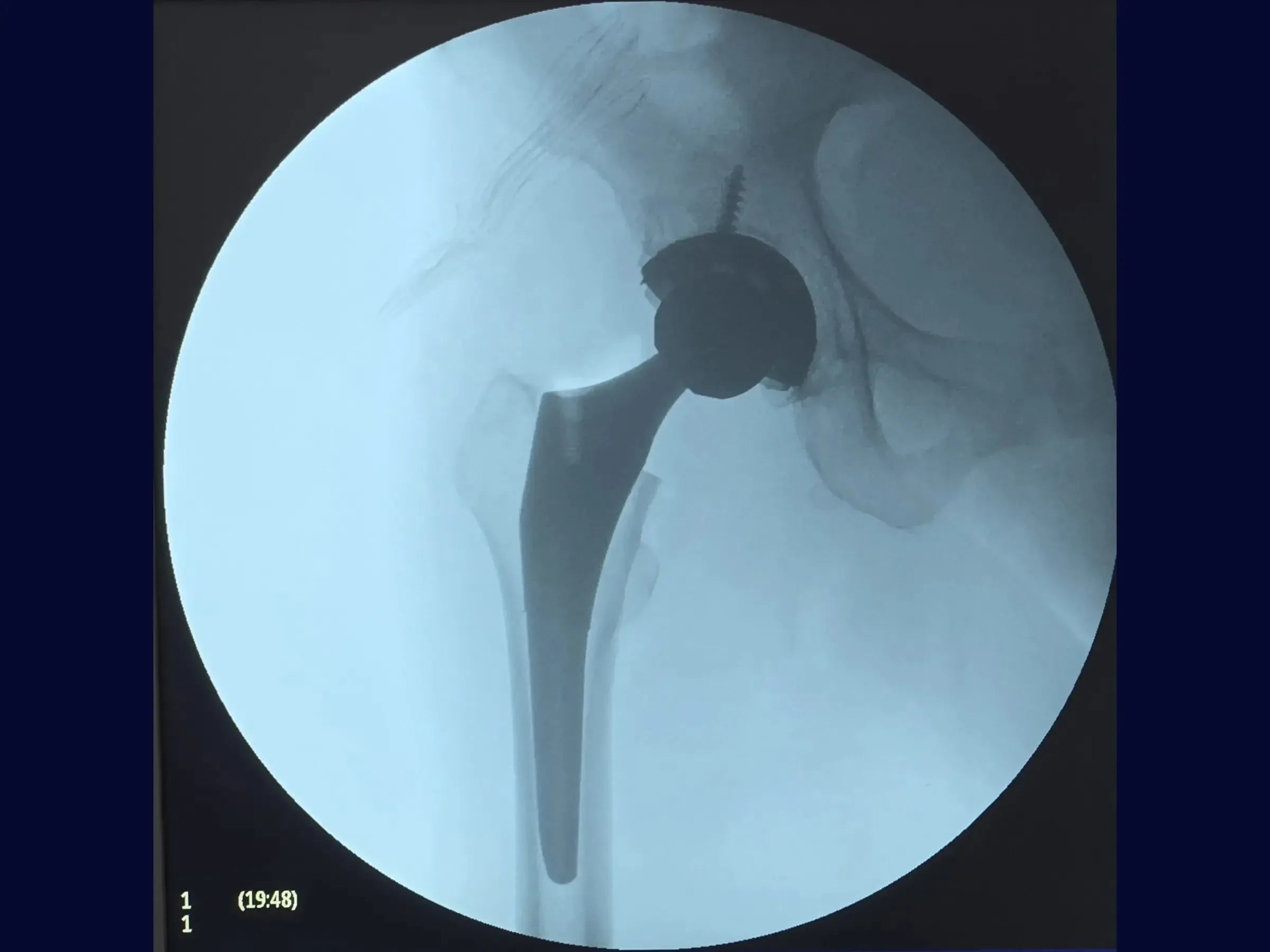 Total Hip Arthroplasty – Posterior Approach (04)