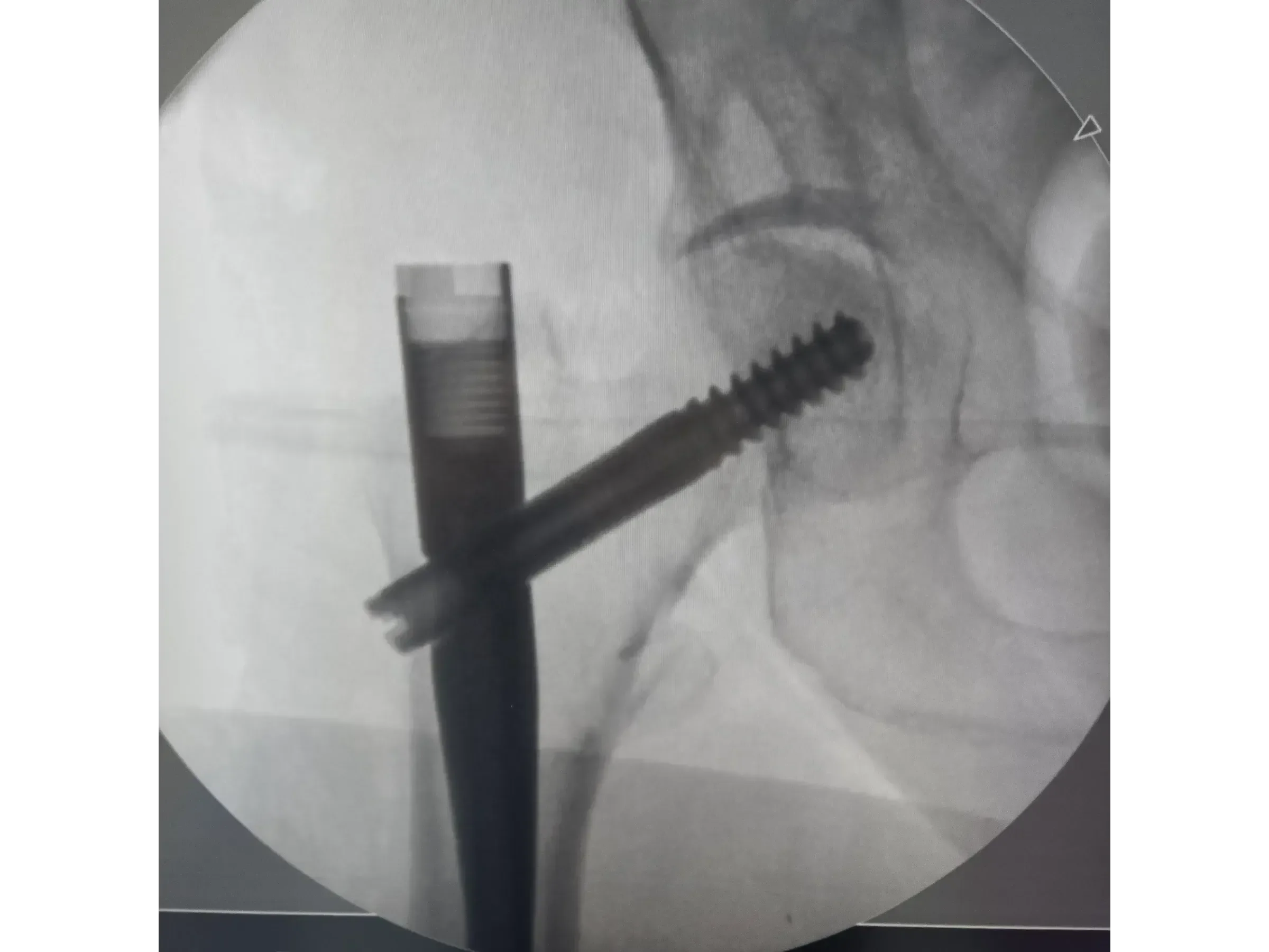 Intramedullärer Nagel für den proximalen Femur 03 – Rocker (Wippen)-Manöver