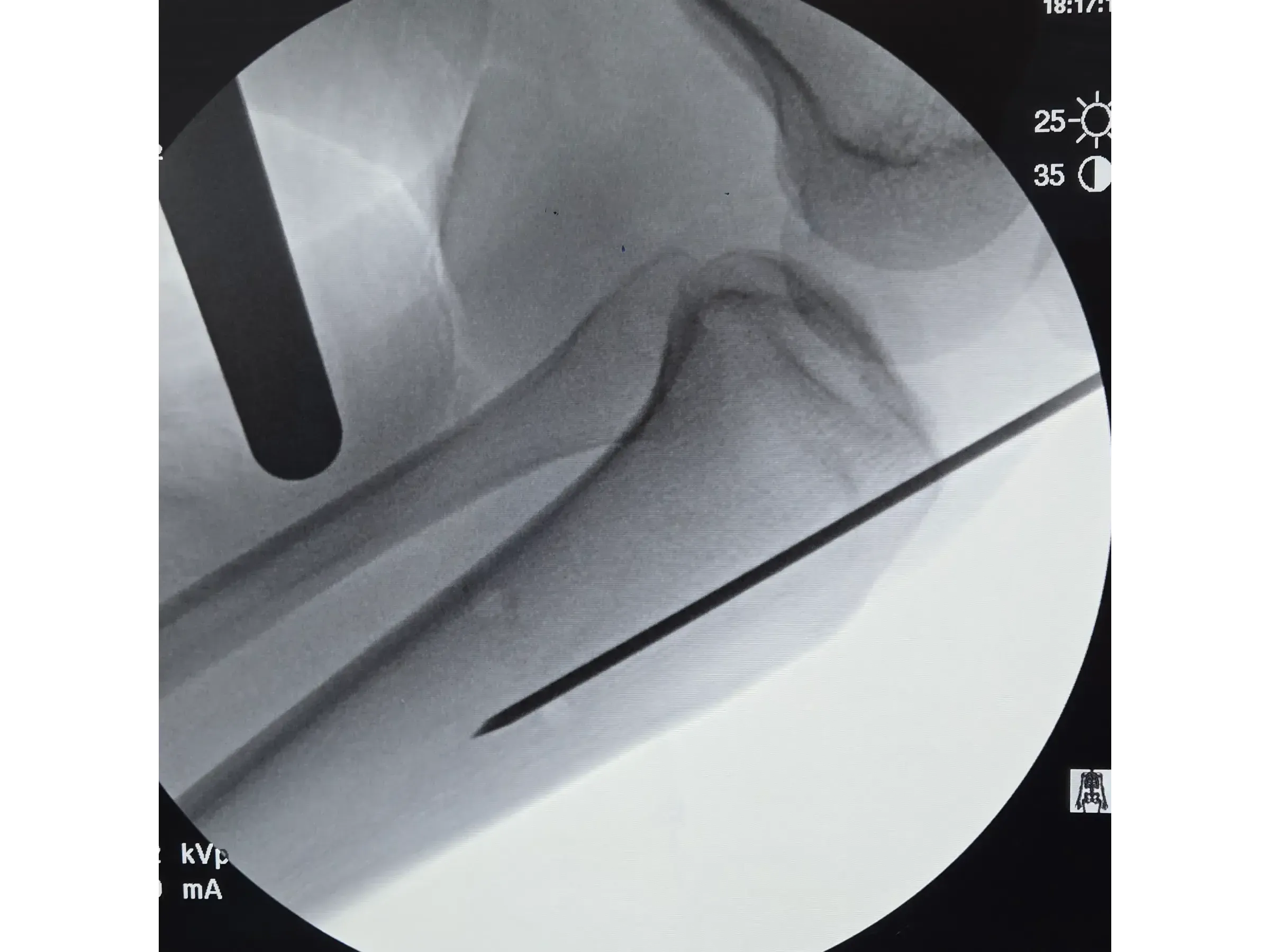 Intramedulläre Tibianagelung – Infrapatellarer Zugang