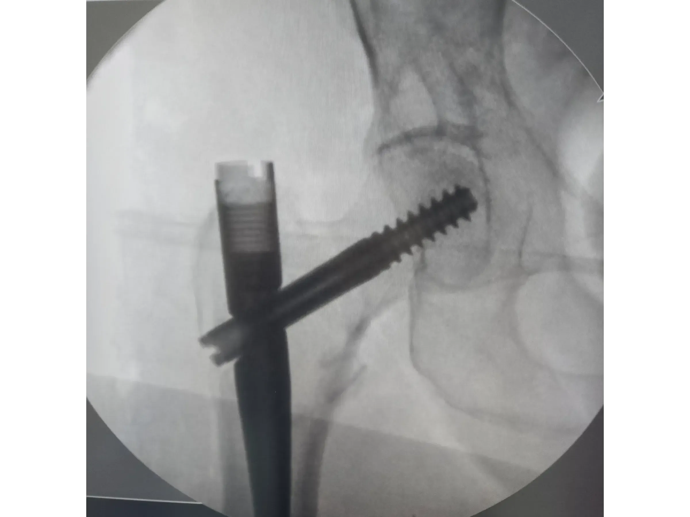 Intramedullärer Nagel für den proximalen Femur 03 – Rocker (Wippen)-Manöver