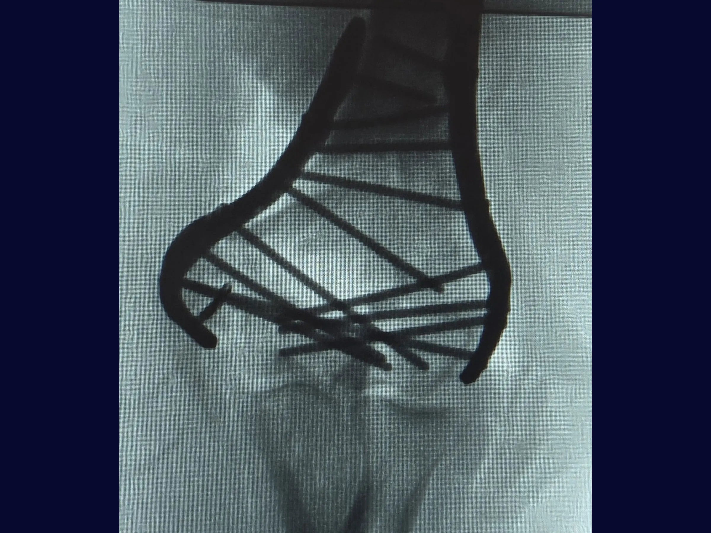 Comminuted Articular Fracture of the Distal Humerus