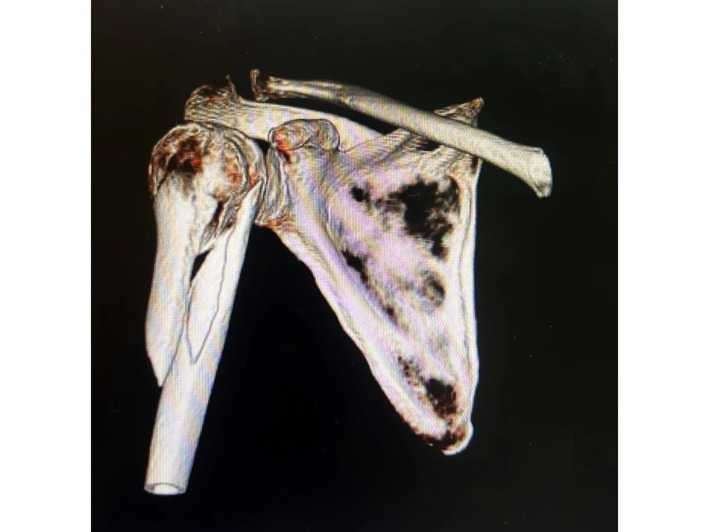 Intramedullärer Nagel für den proximalen Humerus