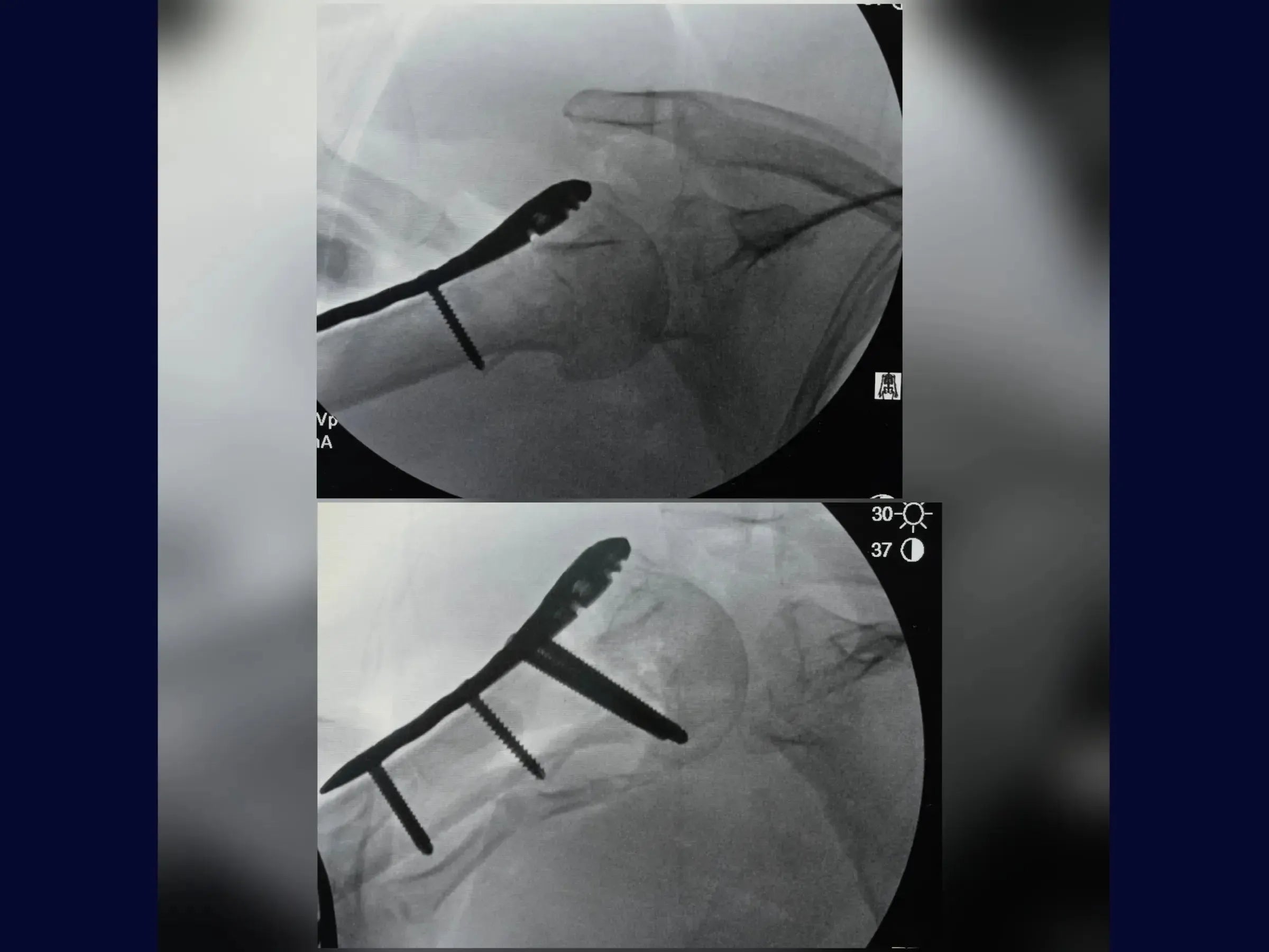Proximal Humerus – Four-Part Fracture (05)