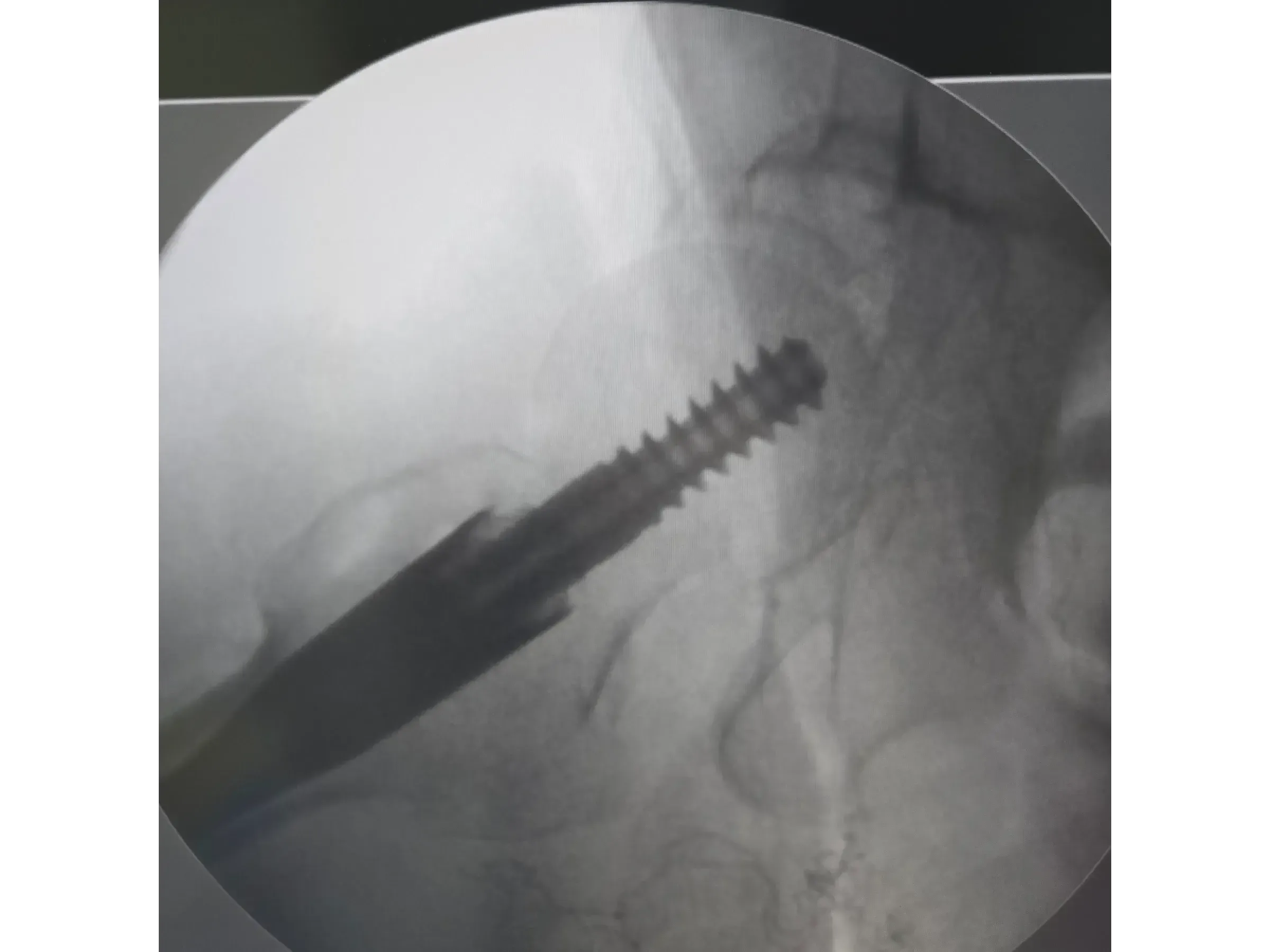 Intramedullärer Nagel für den proximalen Femur 03 – Rocker (Wippen)-Manöver