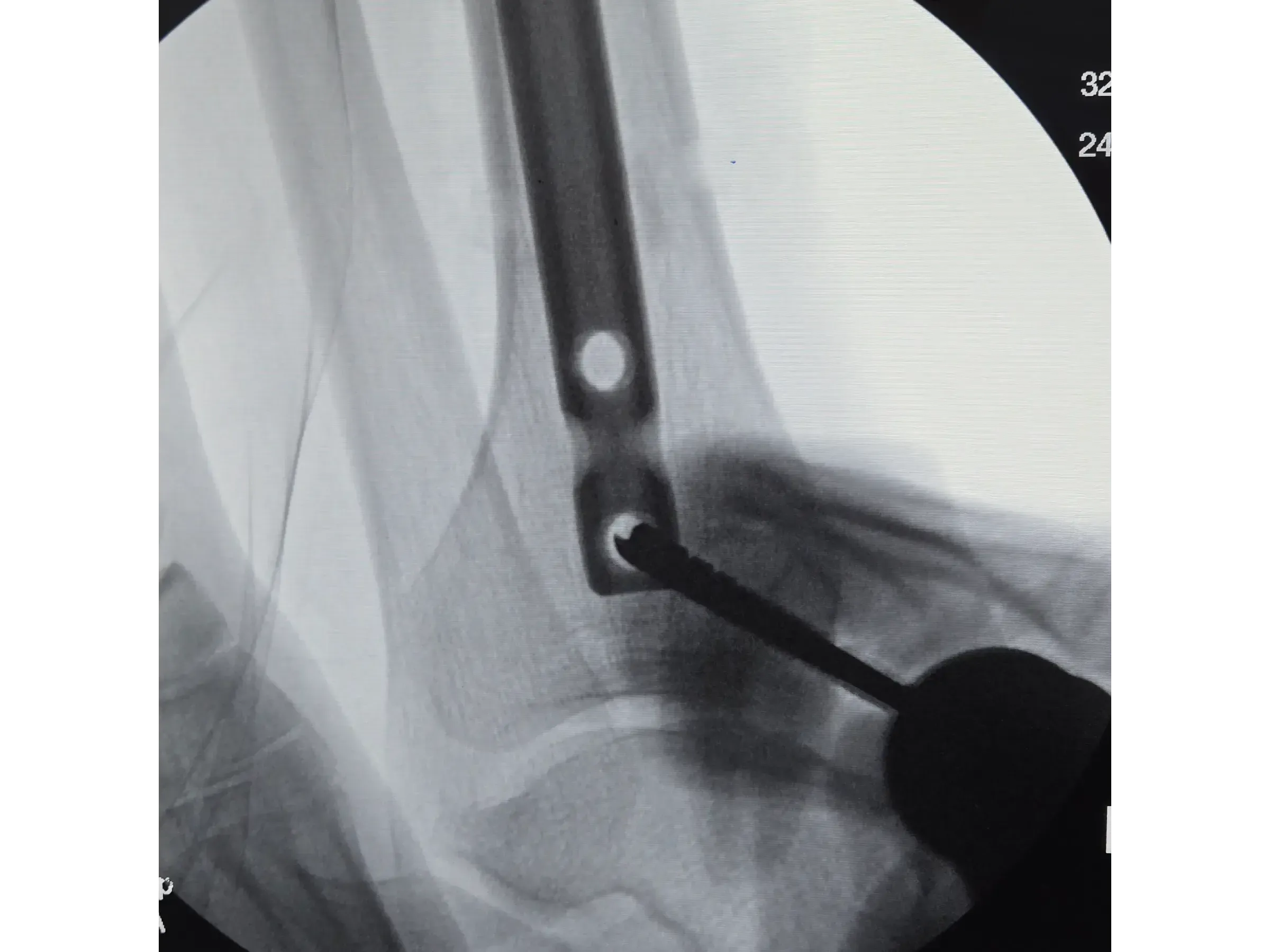 Intramedulläre Tibianagelung – Infrapatellarer Zugang