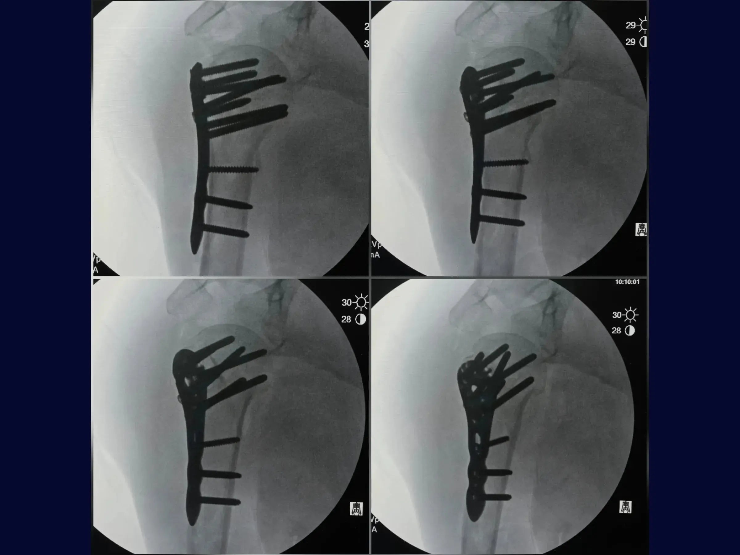 Proximal Humerus – Four-Part Fracture (05)
