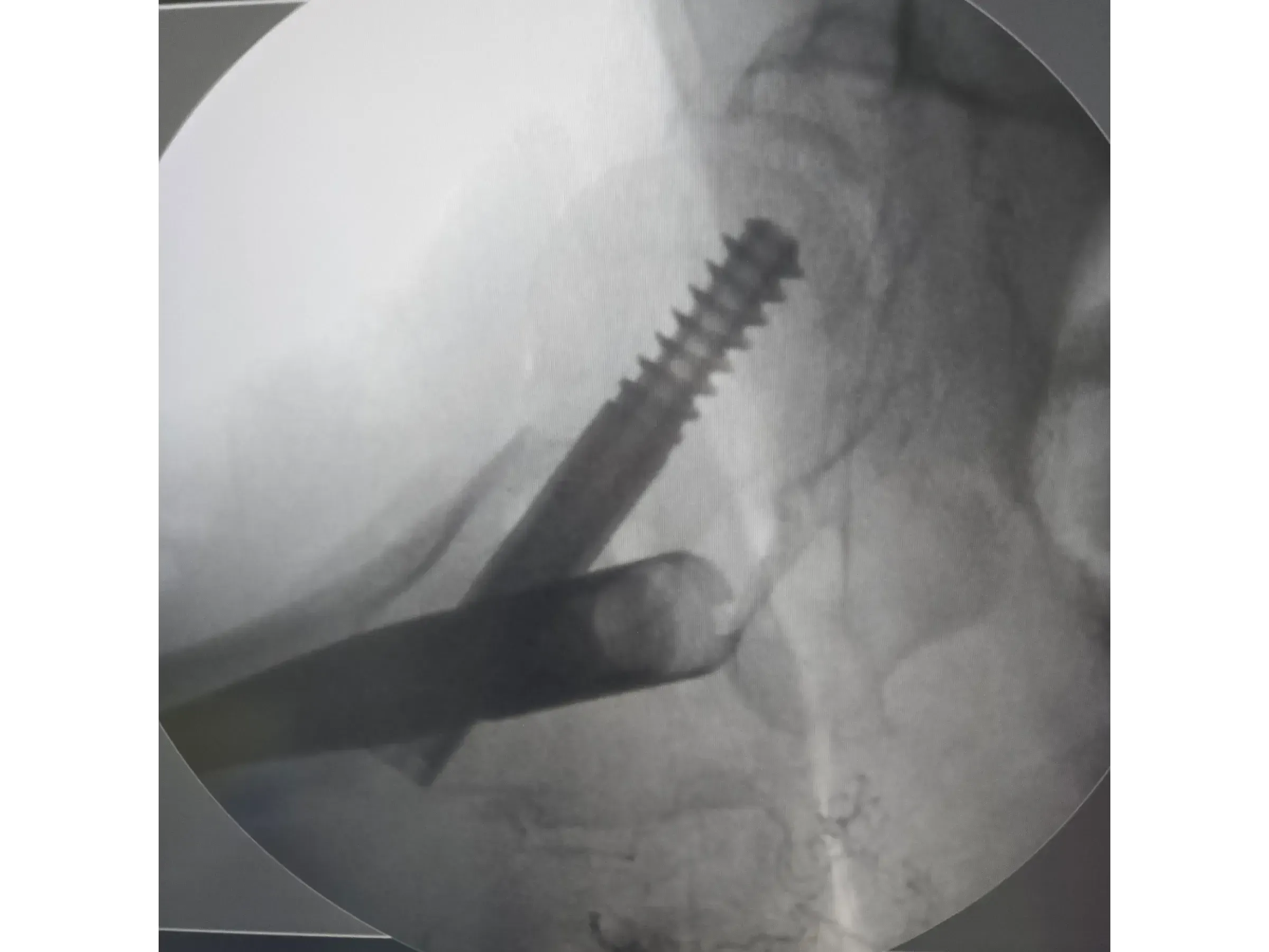 Intramedullärer Nagel für den proximalen Femur 03 – Rocker (Wippen)-Manöver