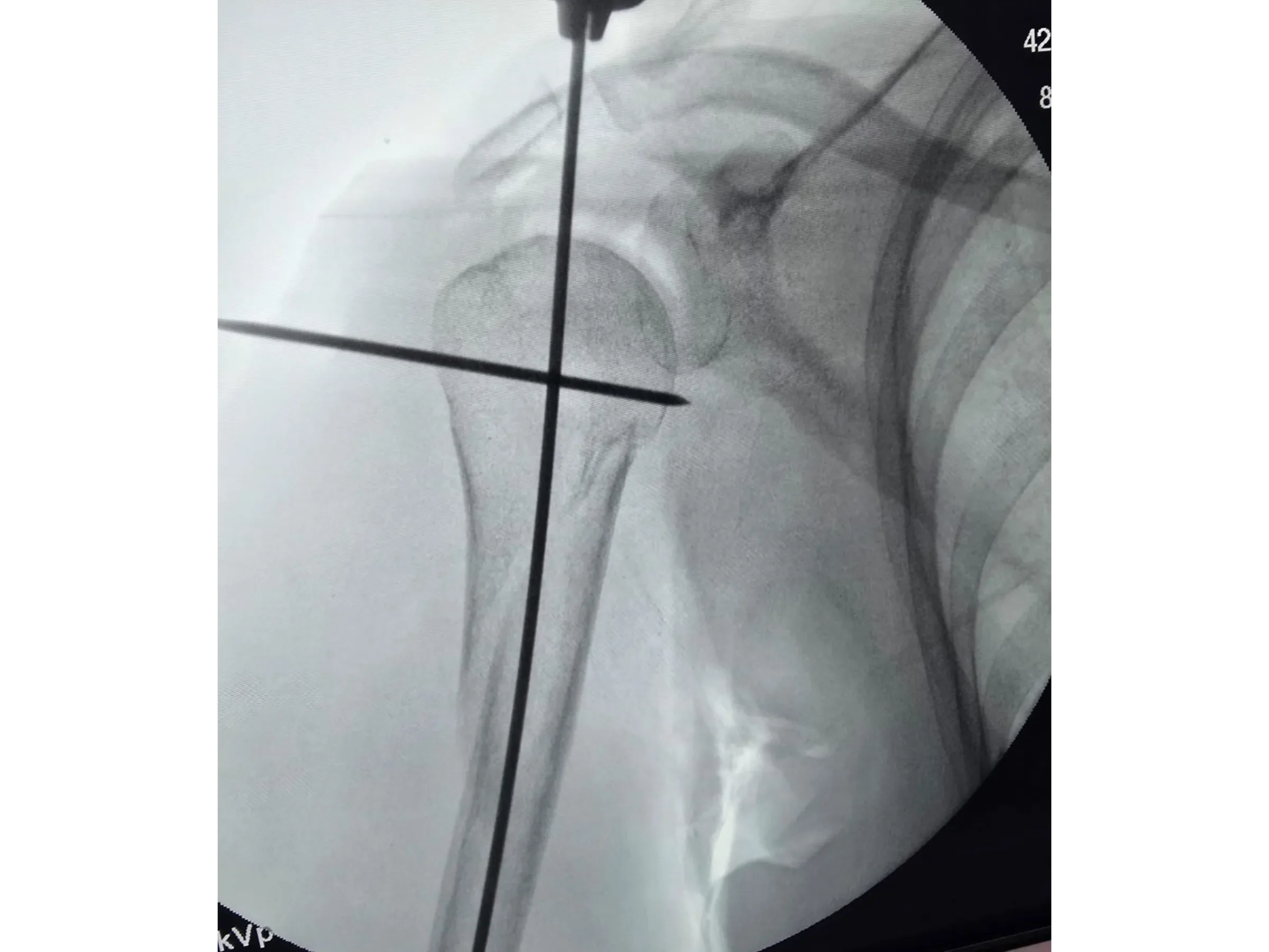 Intramedullärer Nagel für den proximalen Humerus