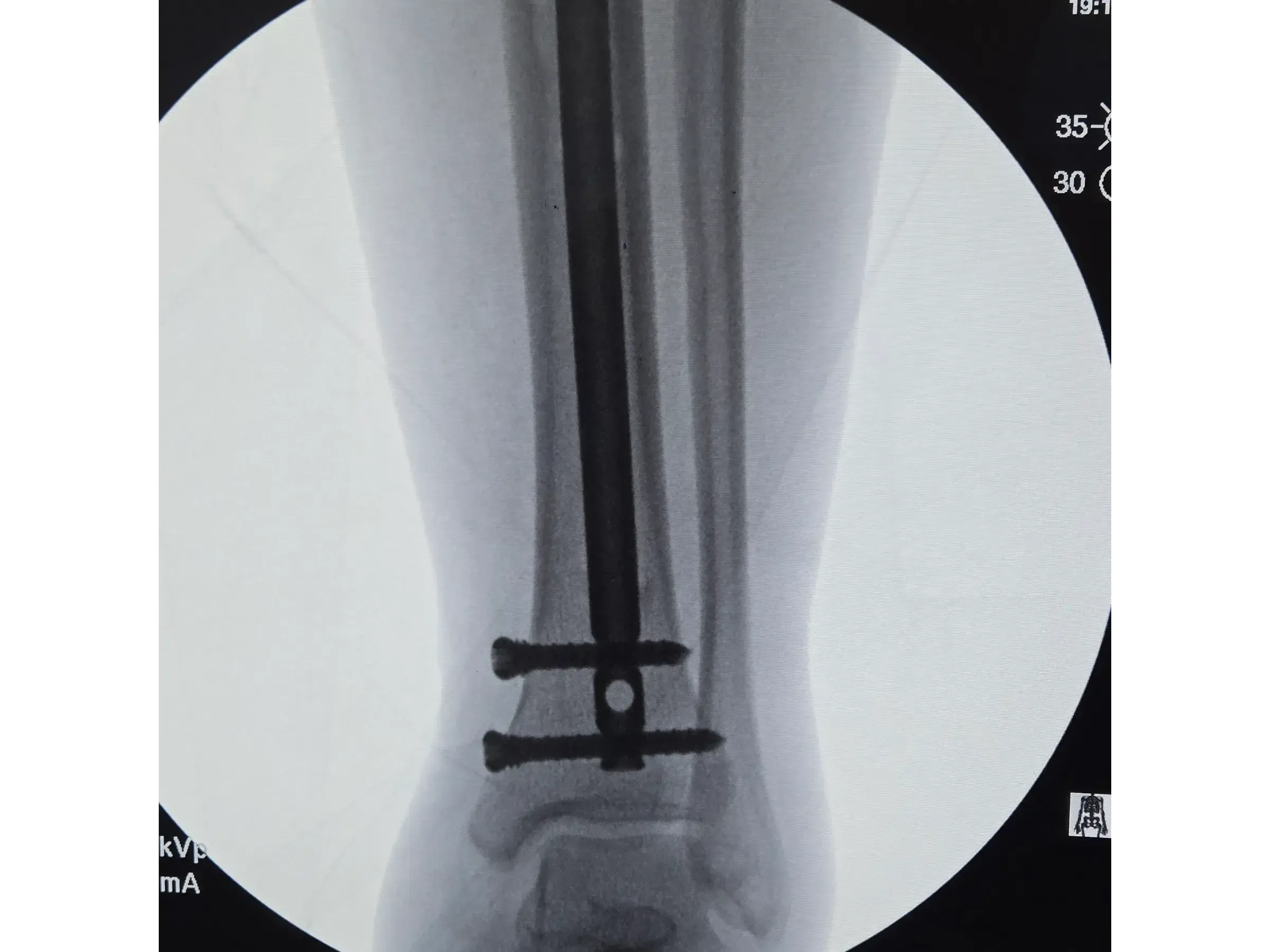 Intramedulläre Tibianagelung – Infrapatellarer Zugang