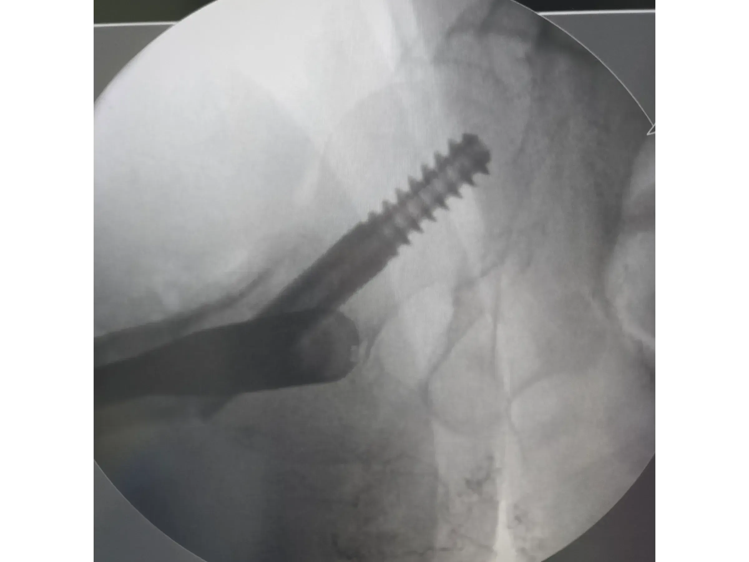 Intramedullärer Nagel für den proximalen Femur 03 – Rocker (Wippen)-Manöver