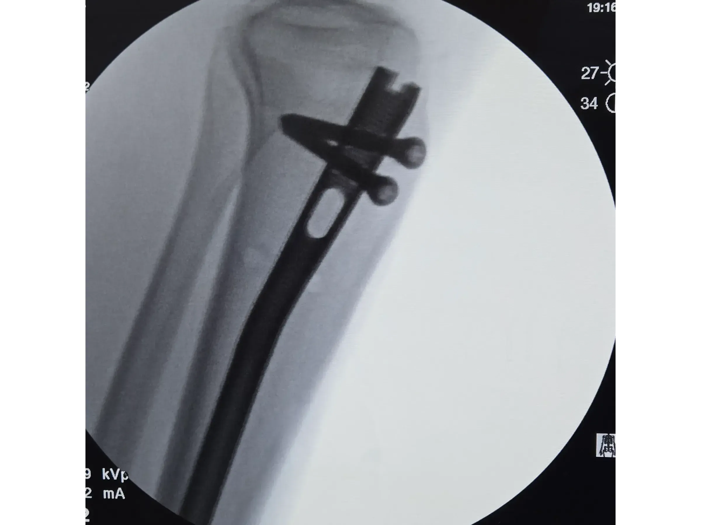 Intramedulläre Tibianagelung – Infrapatellarer Zugang