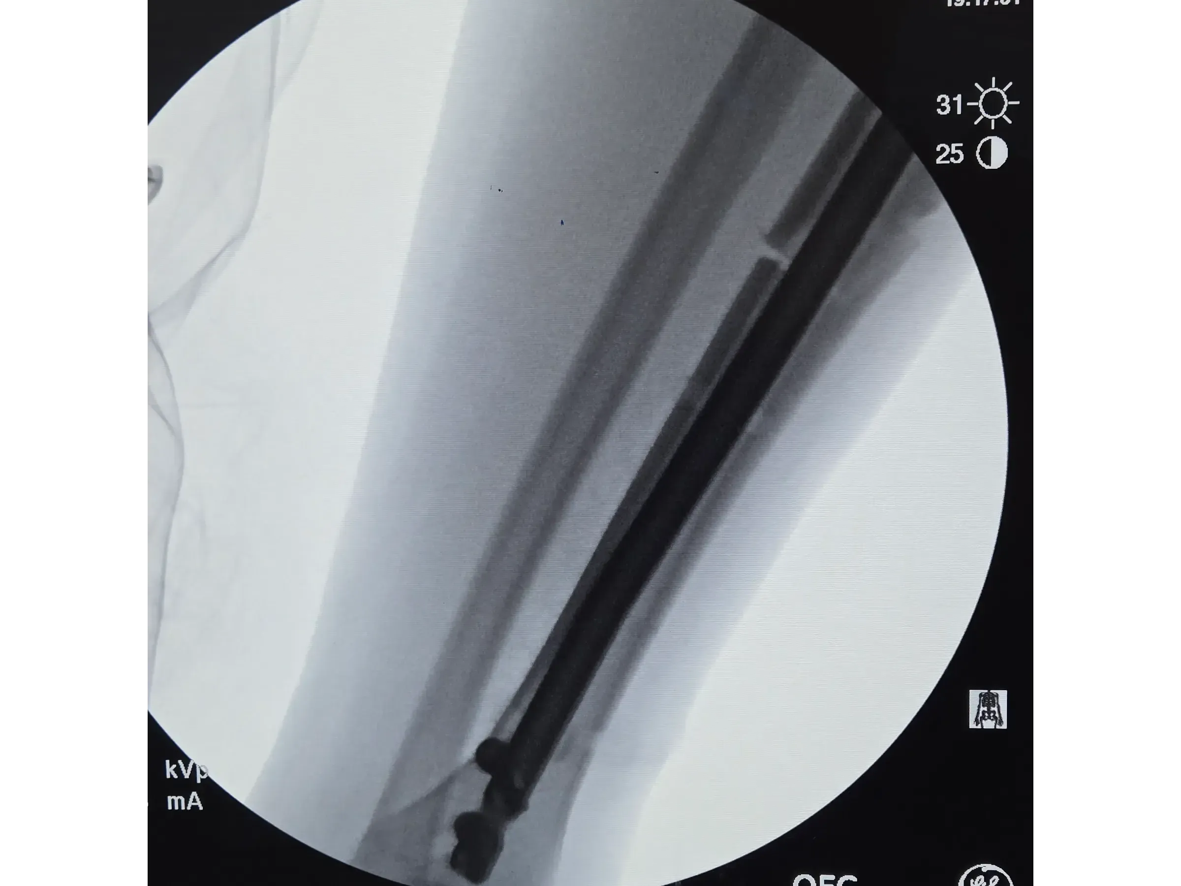 Intramedulläre Tibianagelung – Infrapatellarer Zugang