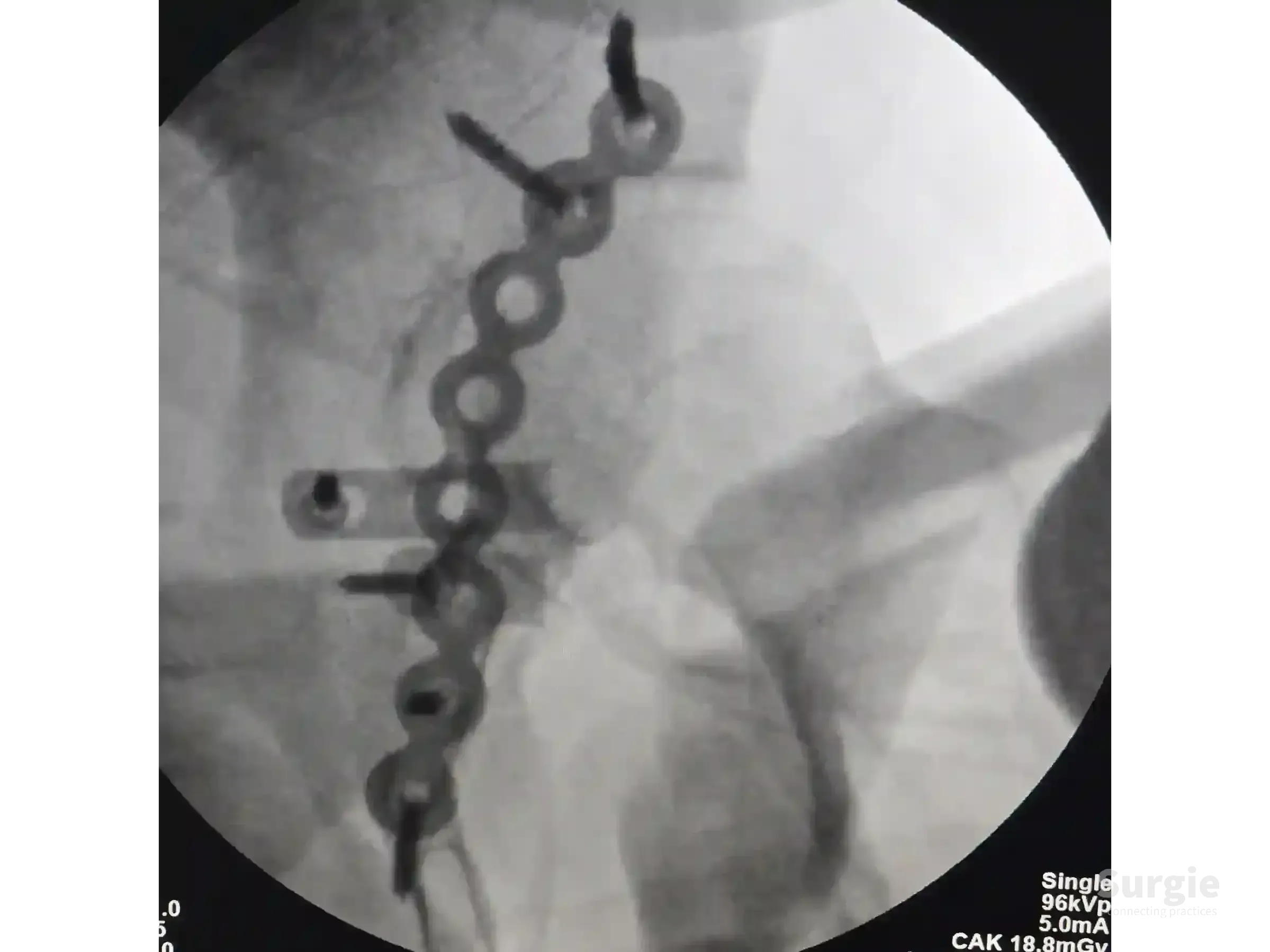 Fluoroscopic view of a posterior acetabular fracture fixed with a contoured metal plate and spring plates.