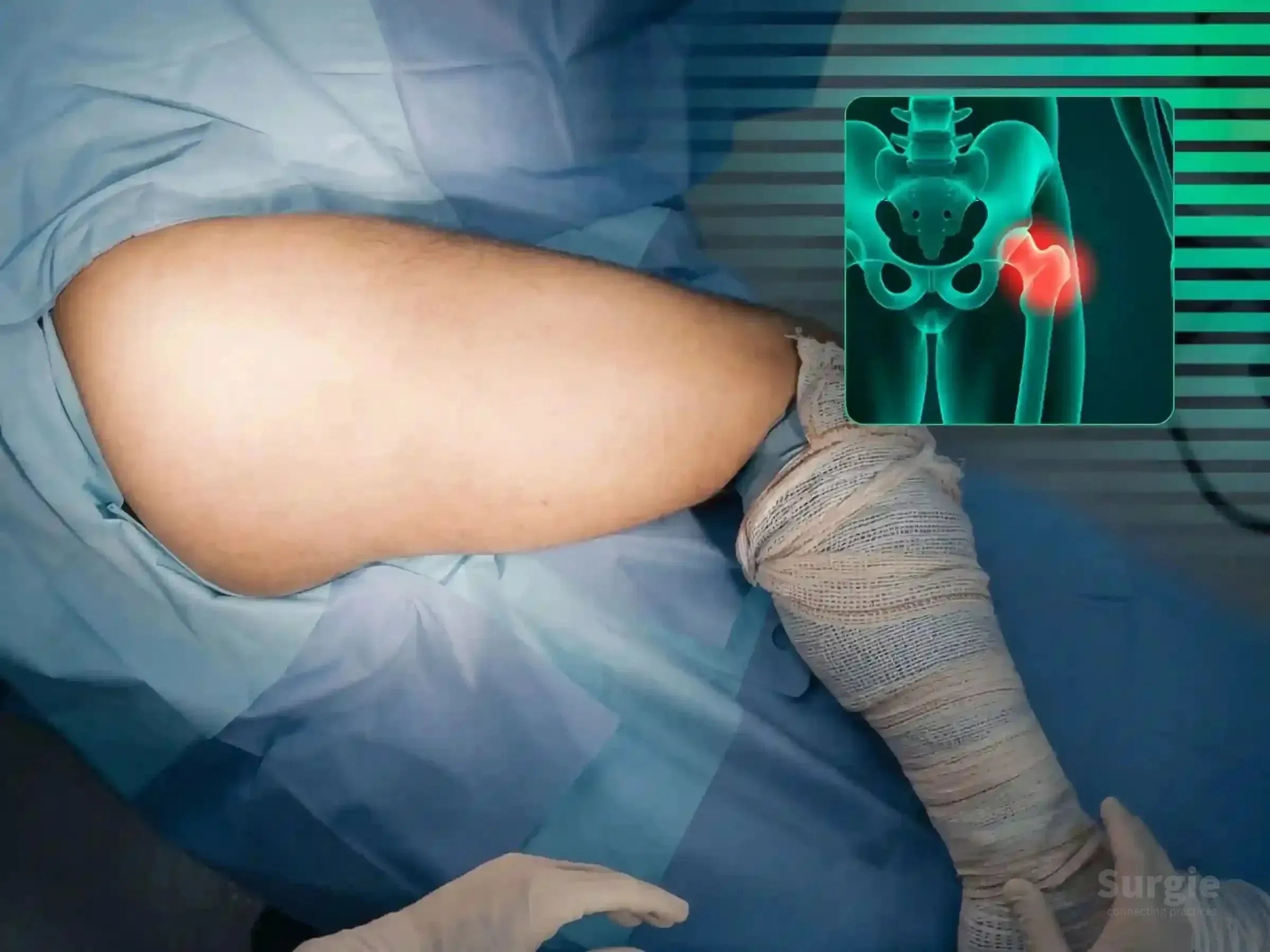 Surgical preparation for acetabular fracture with an anatomical 3D hip overlay showing posterior rim and articular impaction.