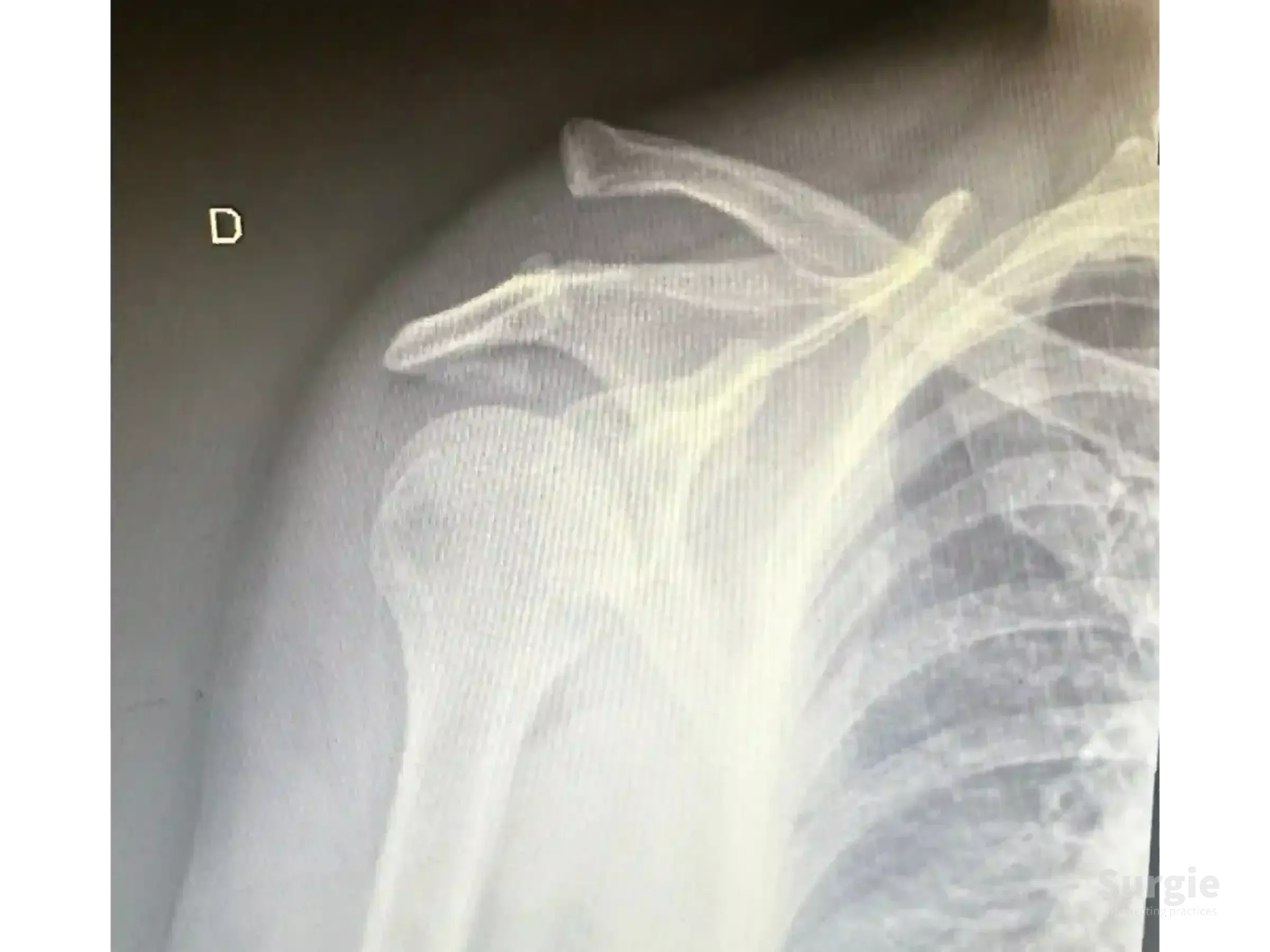 Shoulder X-ray showing acromioclavicular joint dislocation with elevated clavicle and coracoid process visibility.