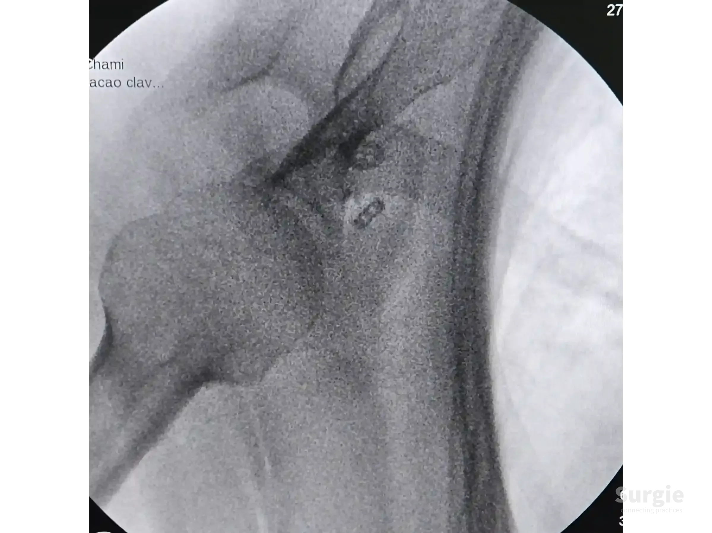 Fluoroscopic view of AC joint TightRope fixation showing metal buttons and sutures securing the clavicle to the coracoid.