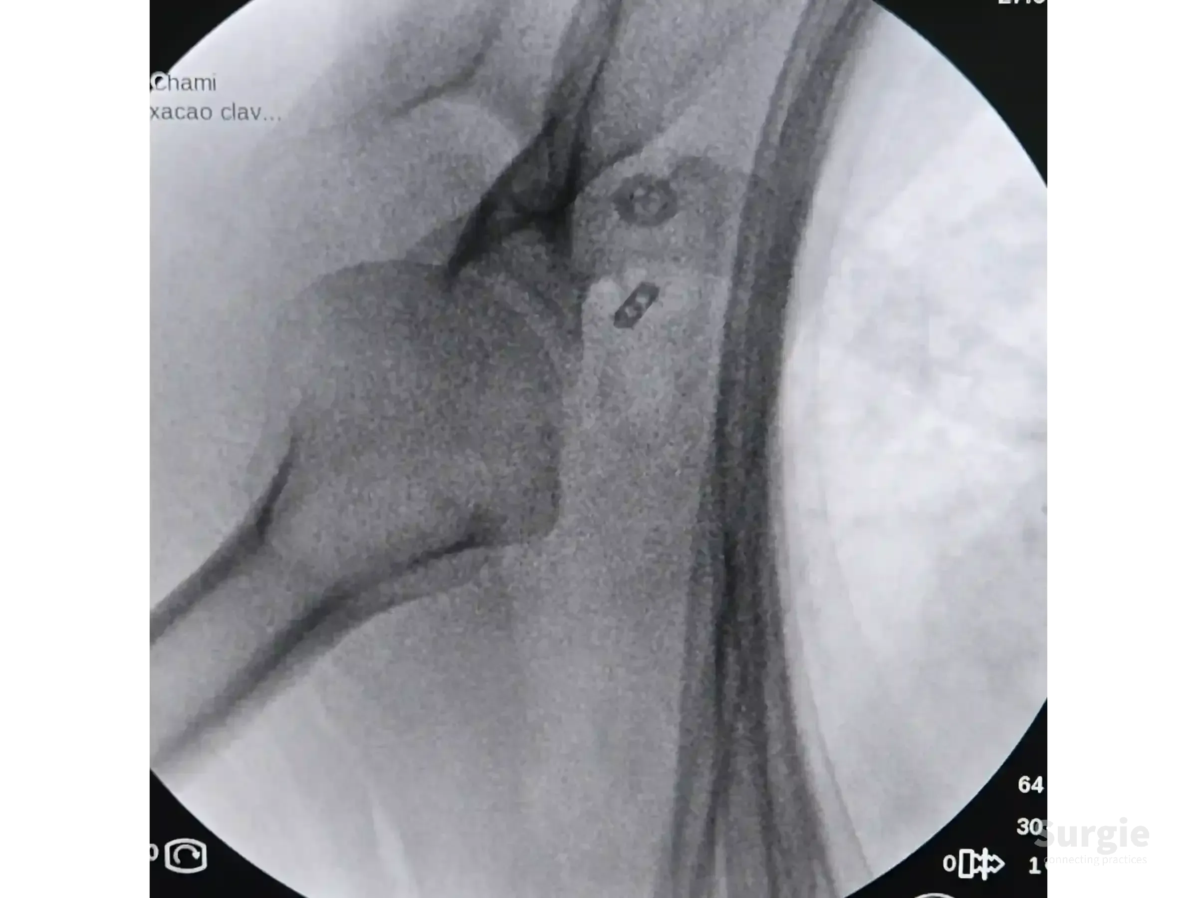 Fluoroscopic view of an AC joint TightRope fixation showing metal buttons securing the clavicle to the coracoid process.