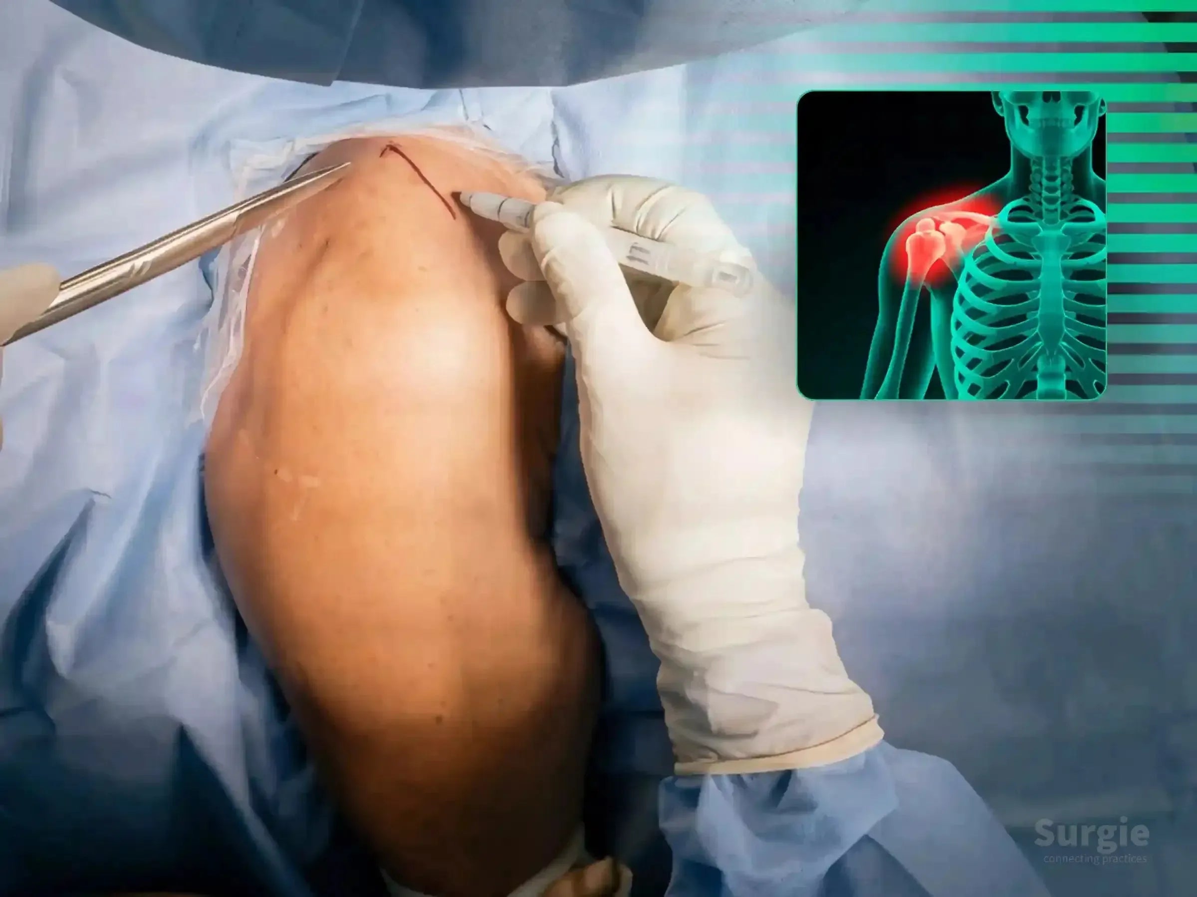 Surgeon marking skin for AC joint TightRope fixation with a digital shoulder anatomy overlay.