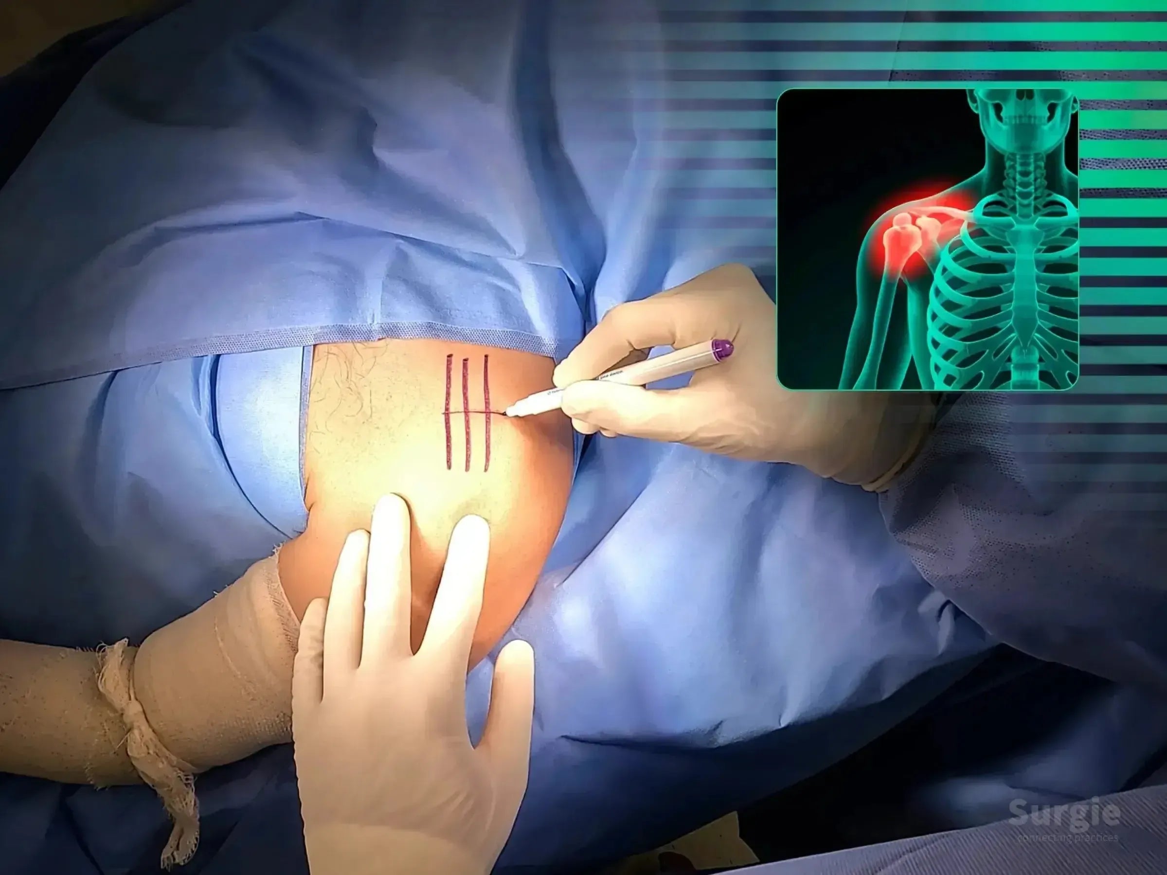Surgeon marking a patient's shoulder for AC joint surgery with a TightRope device, featuring a skeletal X-ray overlay.