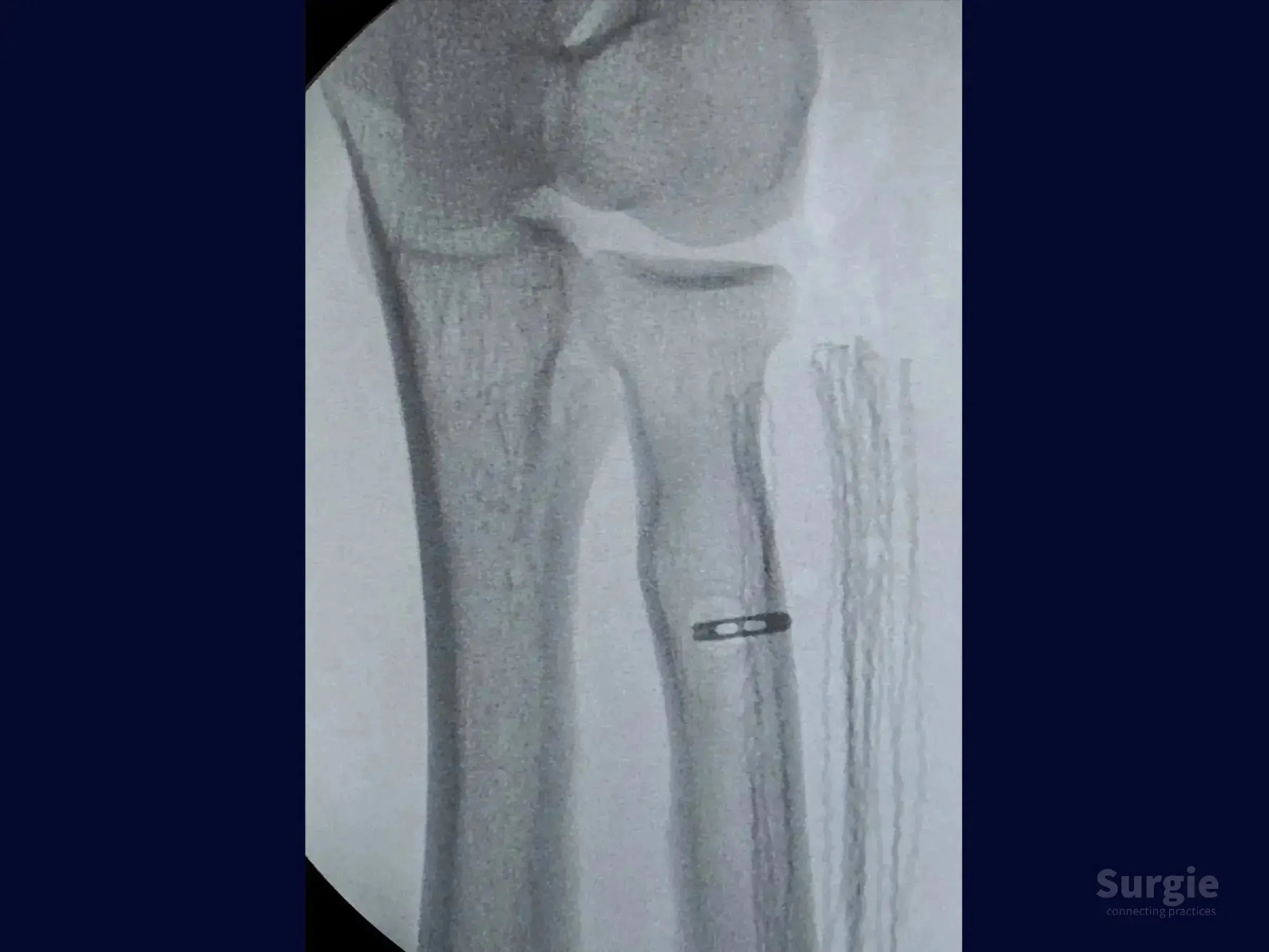 Fluoroscopic X-ray showing a TightRope device implanted in the radial tuberosity for distal biceps tendon reconstruction.
