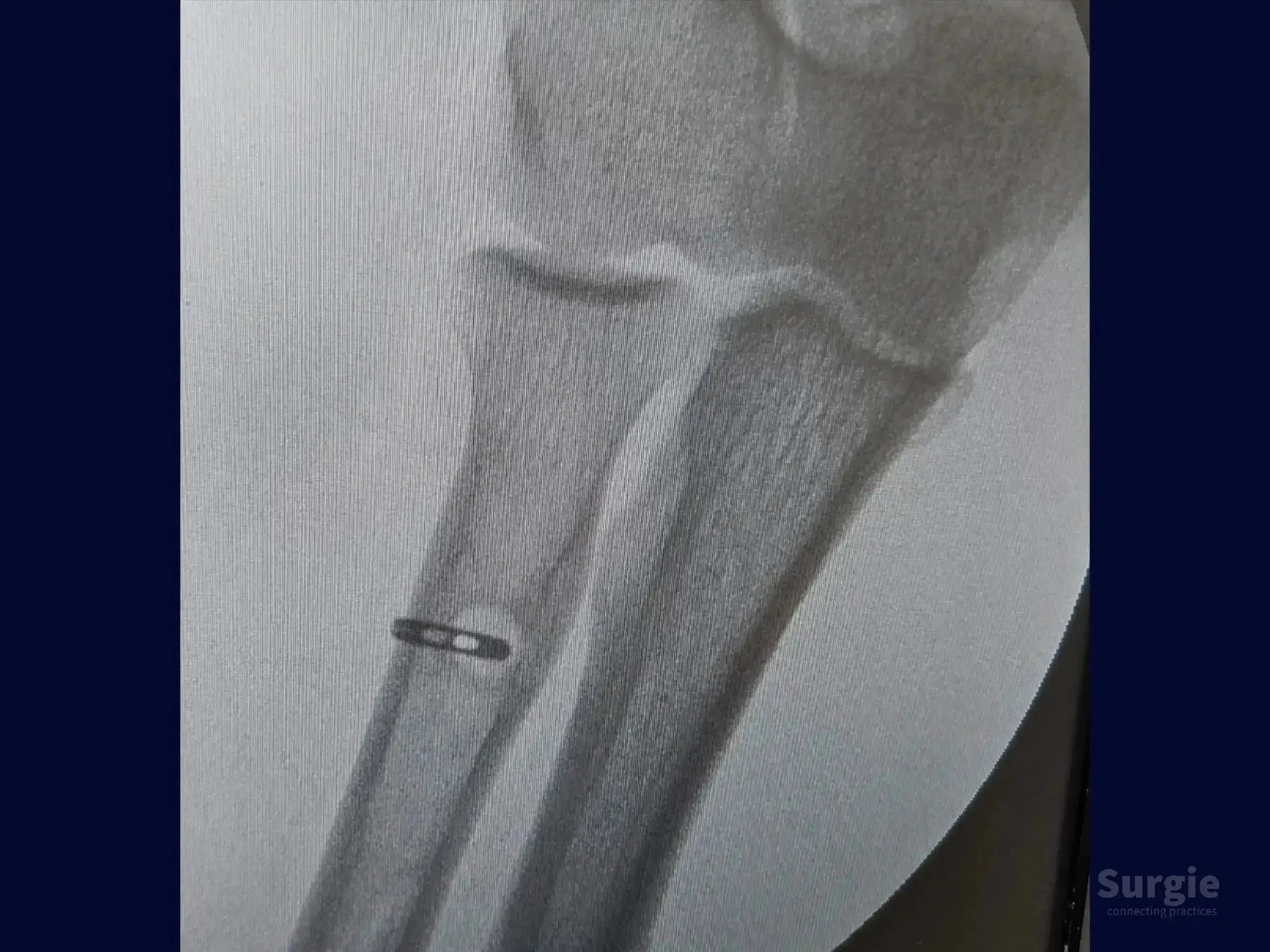 X-ray showing a TightRope device fixating the distal biceps tendon to the radial tuberosity in a grayscale medical view.
