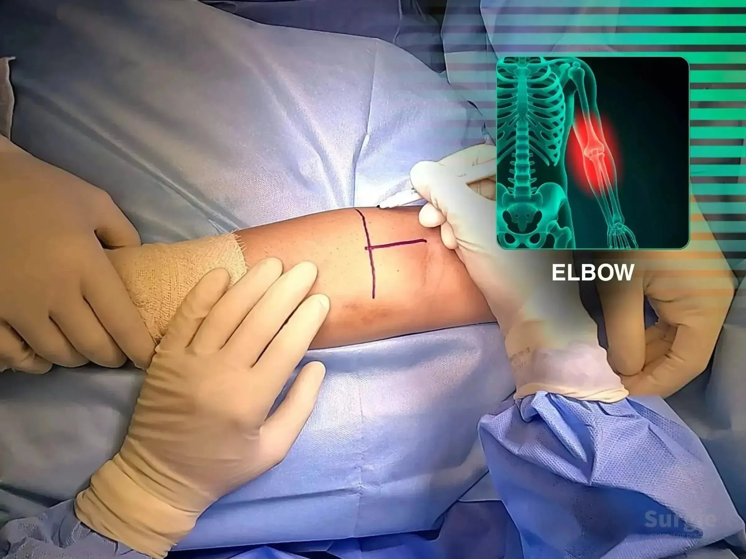 Surgeon marking a patient's arm for distal biceps tendon surgery with an anatomical elbow diagram overlay.