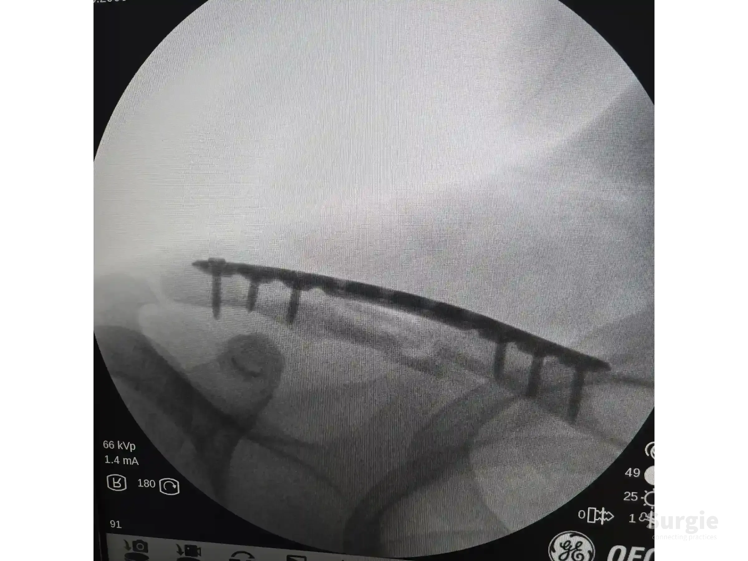 Fluoroscopic X-ray showing a metallic orthopedic plate and screws fixating a midshaft clavicle fracture.