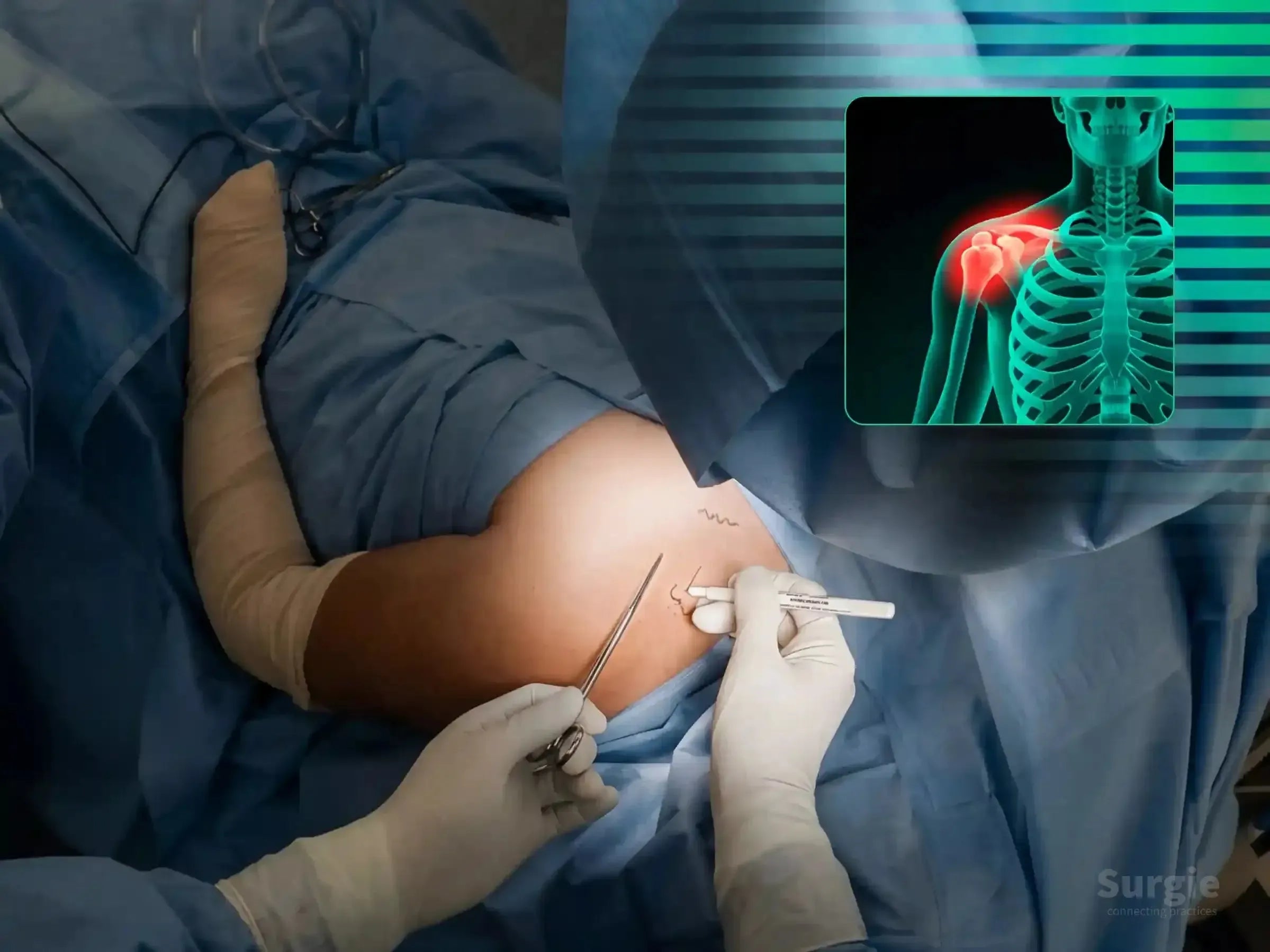 Surgeon marking a clavicle fracture site with an anatomical overlay showing a highlighted shoulder injury.