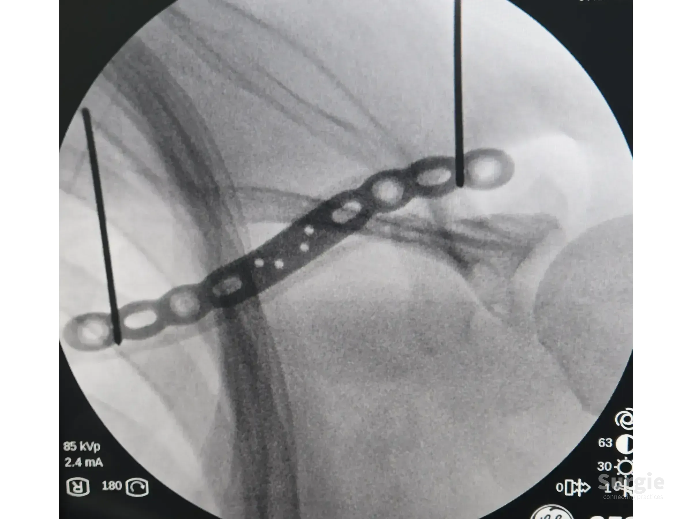 Fluoroscopic view of a clavicle fracture fixed with an anatomic metal plate and guide wires for surgical alignment.