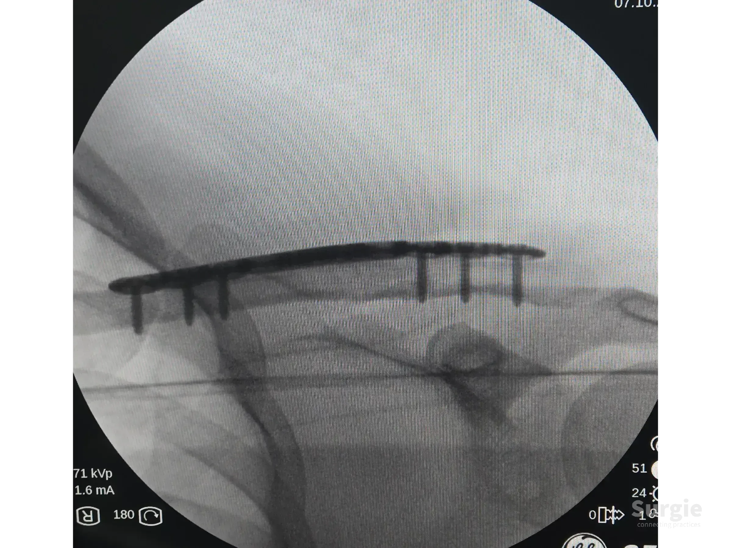 Fluoroscopic view of a metallic anatomic plate fixed to a fractured clavicle with multiple locking screws.