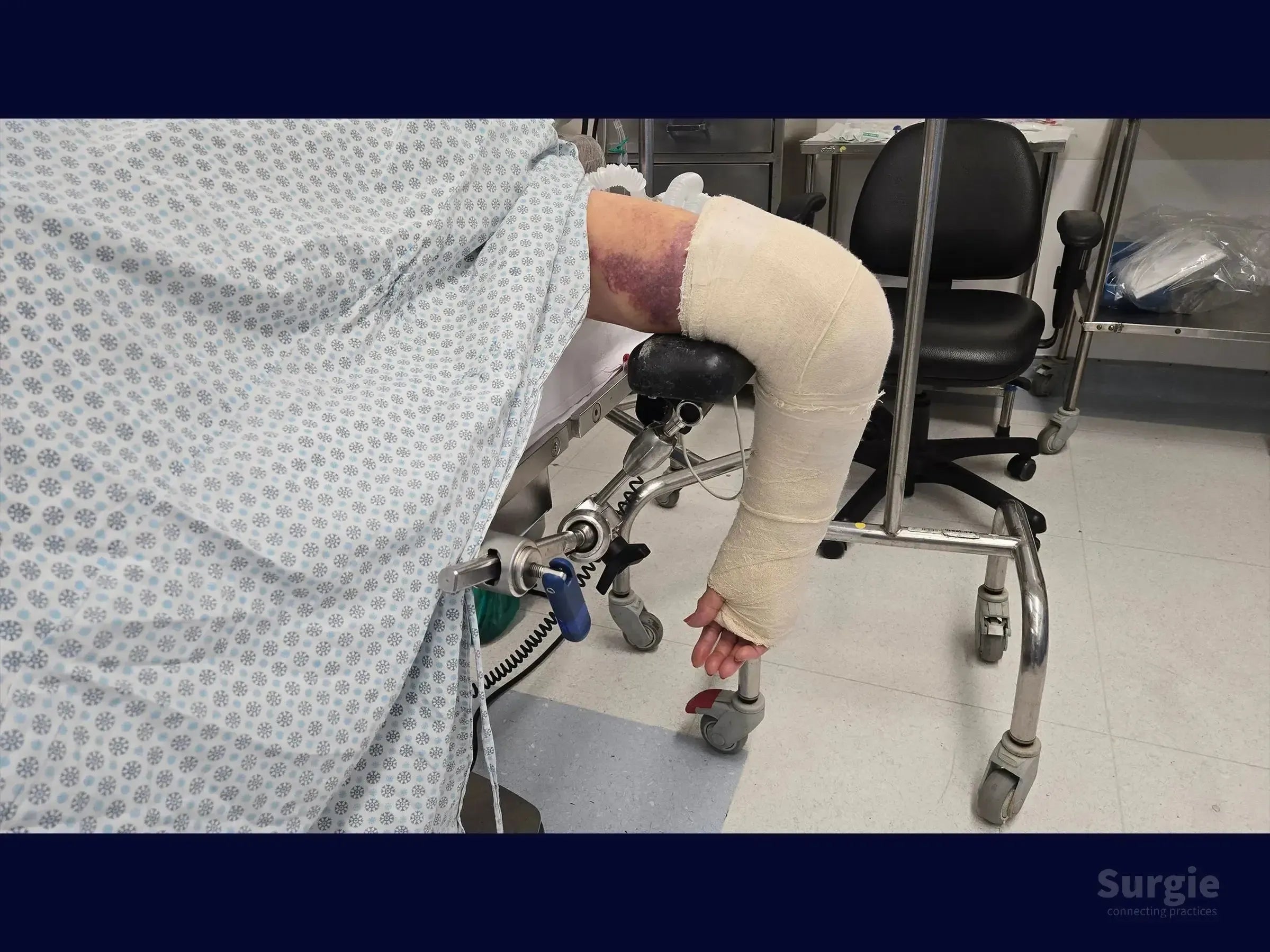 Patient arm with bruising, wrapped in a beige bandage, positioned on a surgical arm board for distal humerus fracture surgery.