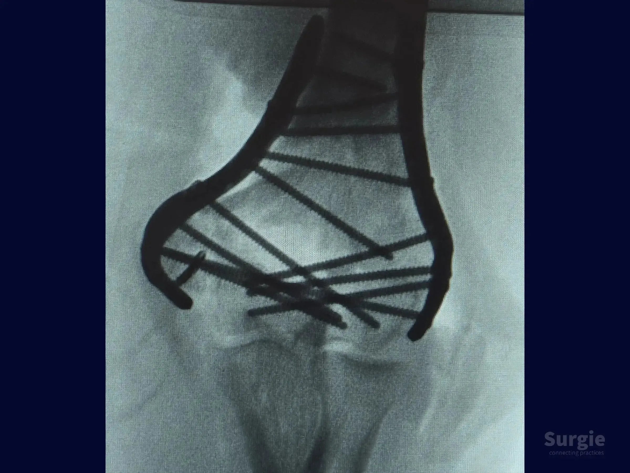 X-ray showing distal humerus fracture fixed with dual metal locking plates and multiple screws for anatomical stability.