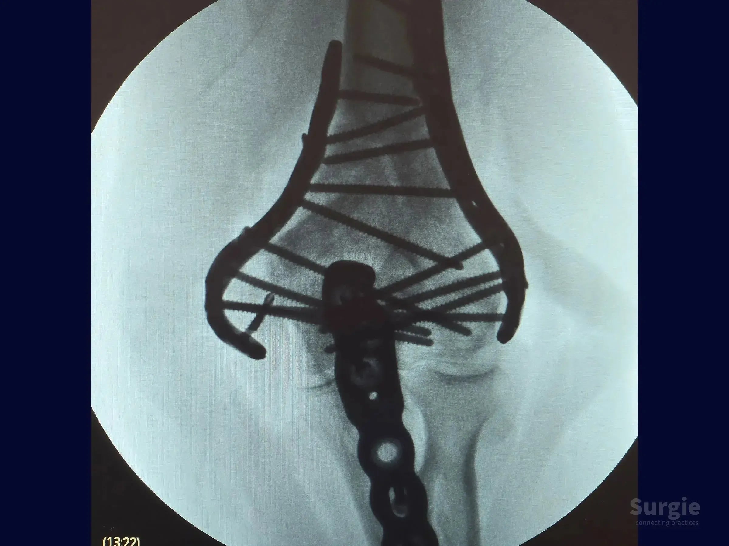 X-ray showing distal humerus fracture fixed with variable-angle locking plates and multiple screws for bone stability.