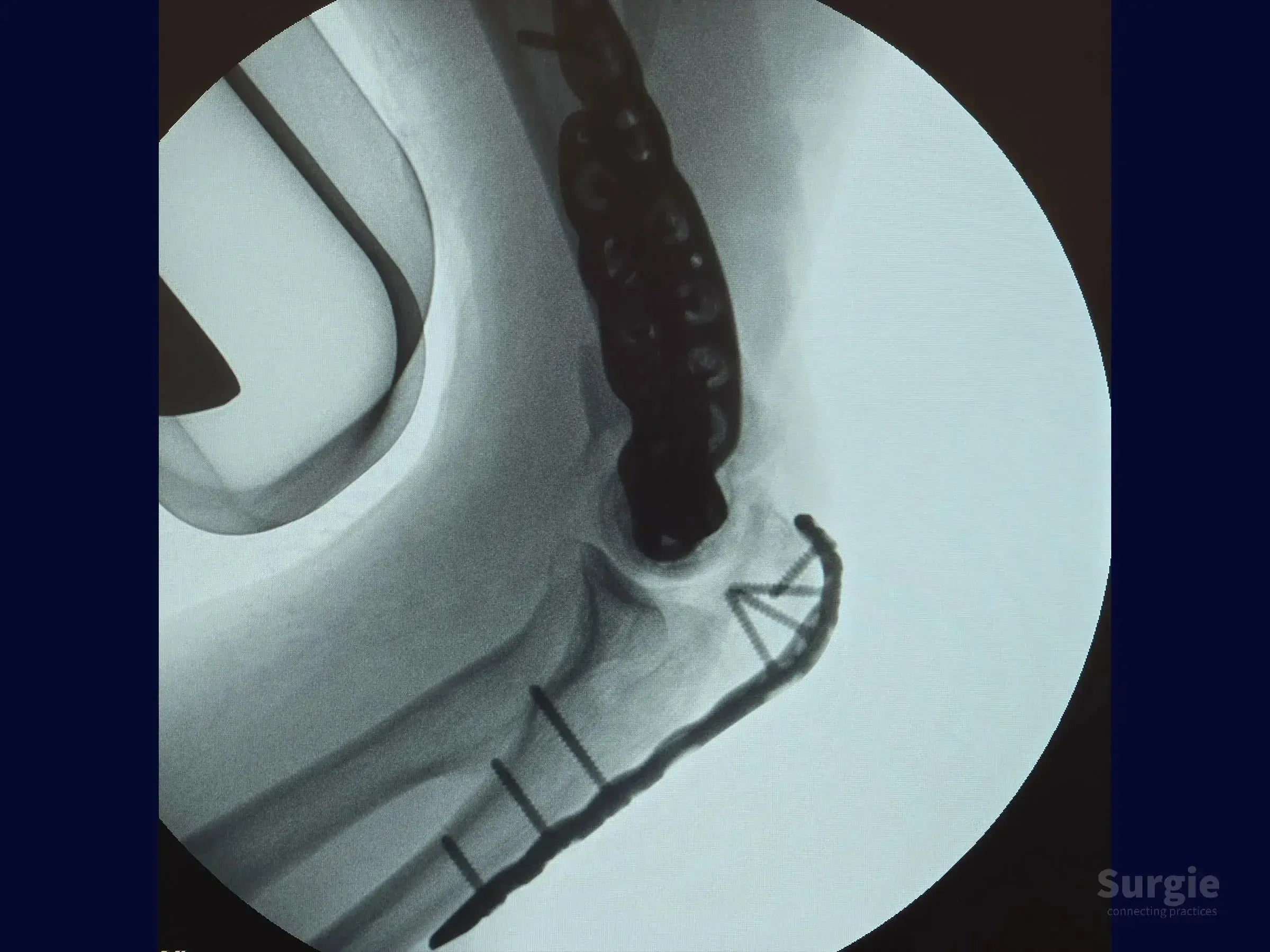 X-ray showing distal humerus fracture fixation with metal locking plates and screws in the elbow joint.