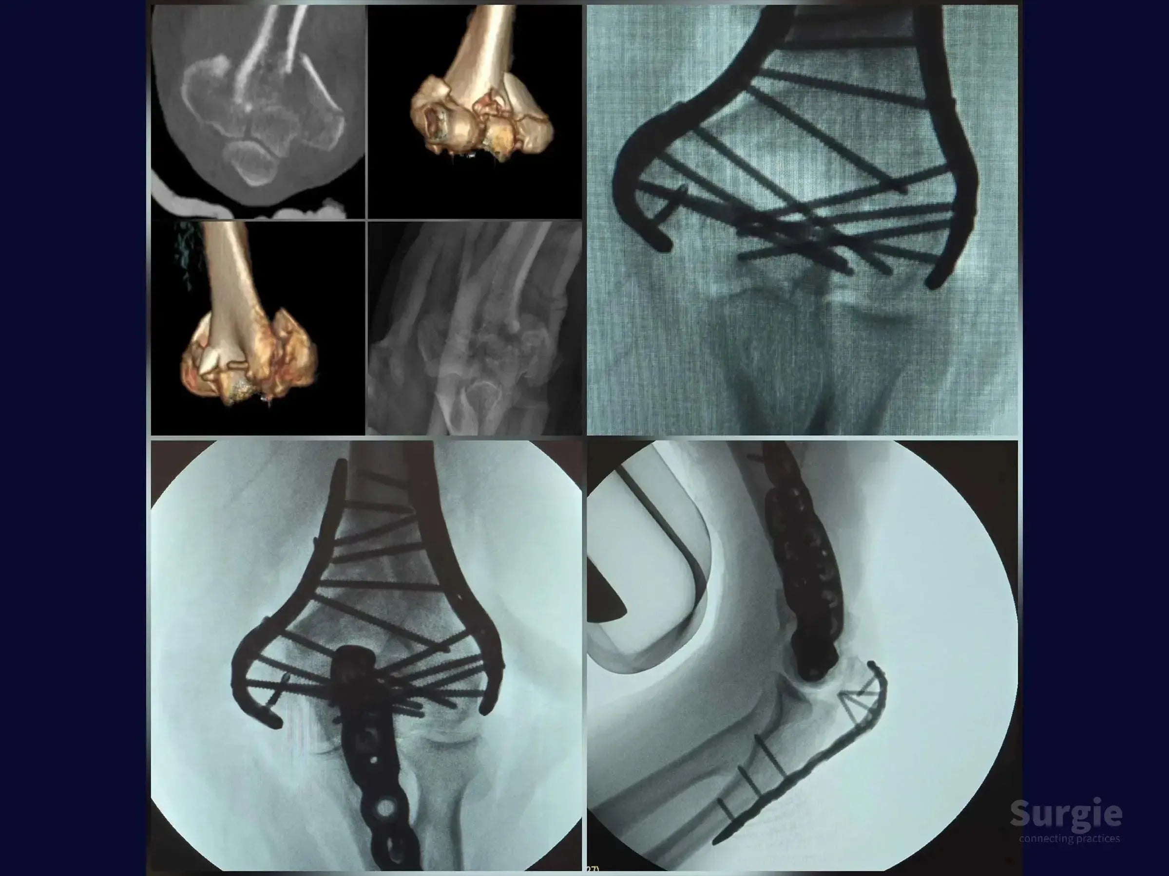 X-ray and 3D CT scans showing distal humerus fracture fixation with metal locking plates and screws for surgical training.