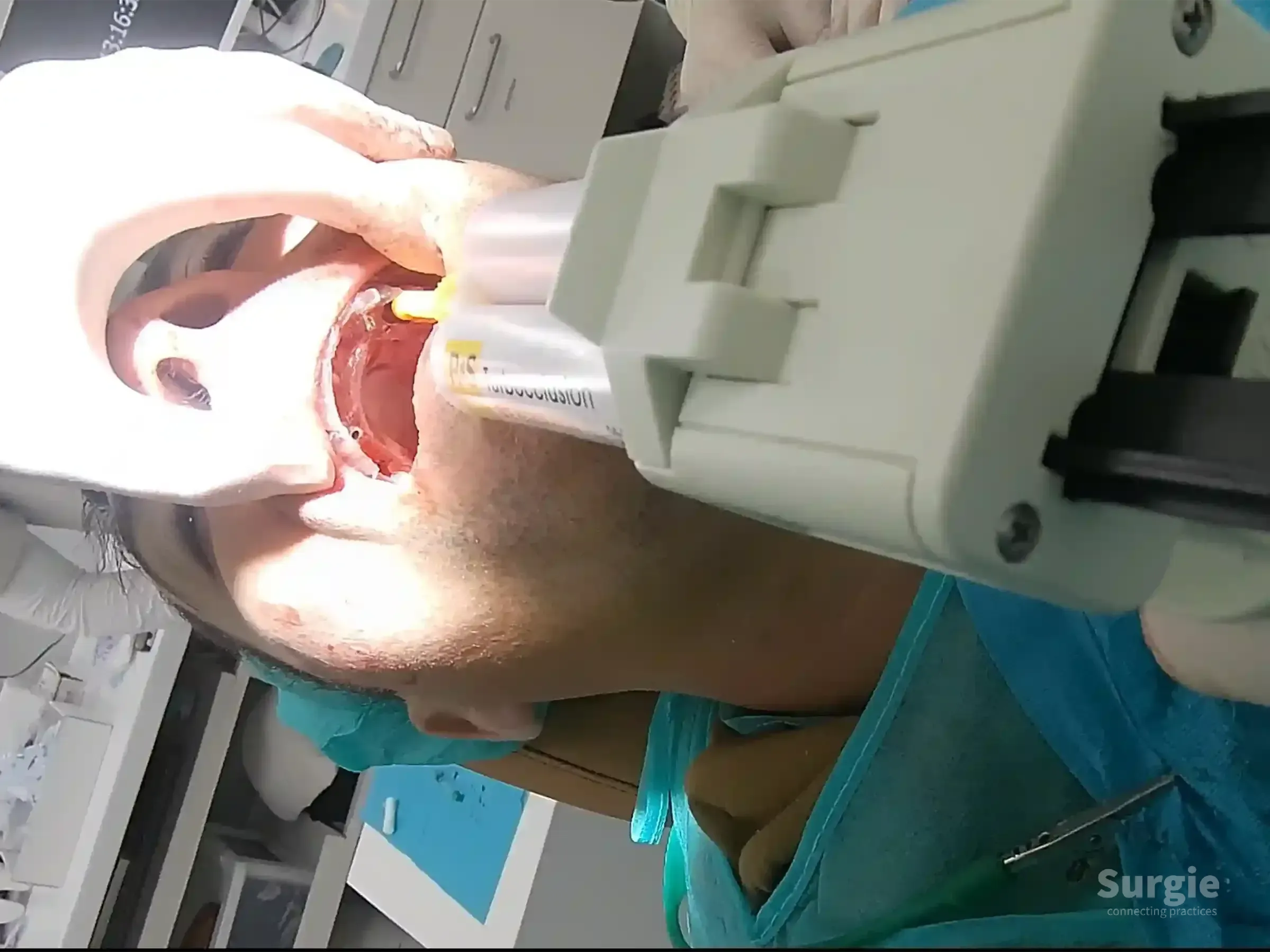 Dentist using a white dual-cartridge impression gun to apply material into a patient's upper arch during an implant procedure.