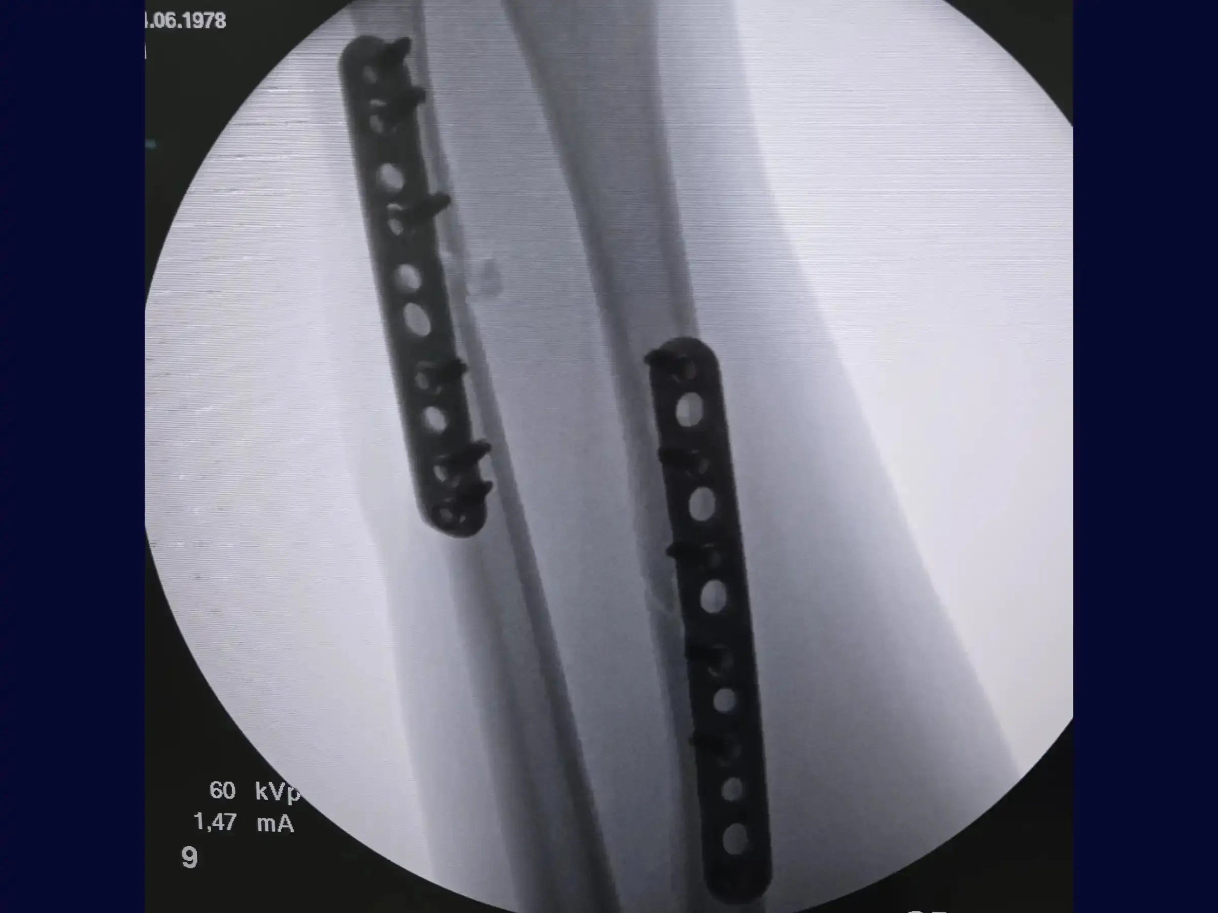 Diaphysäre Frakturen von Radius und Ulna