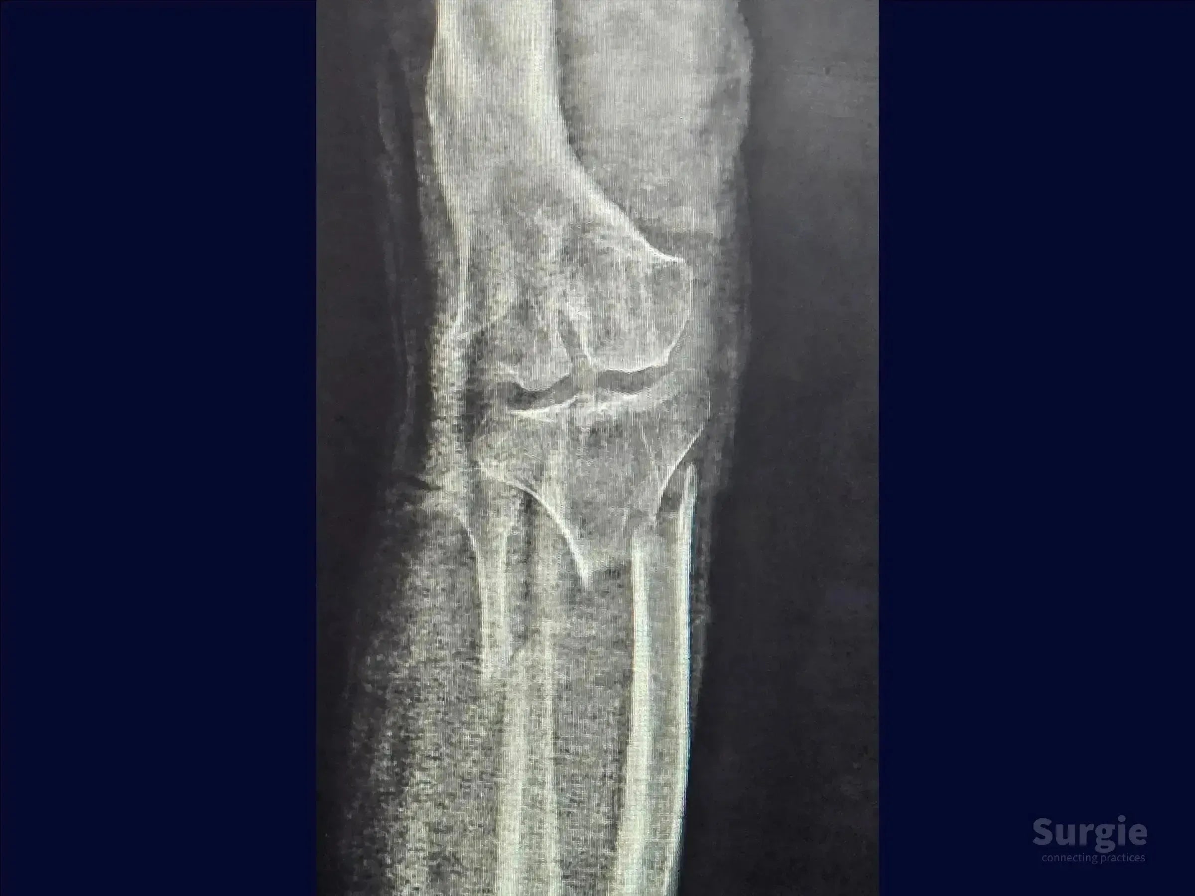 X-ray showing a complex diaphyseal tibia fracture with deformity and osteopenic bone structure.