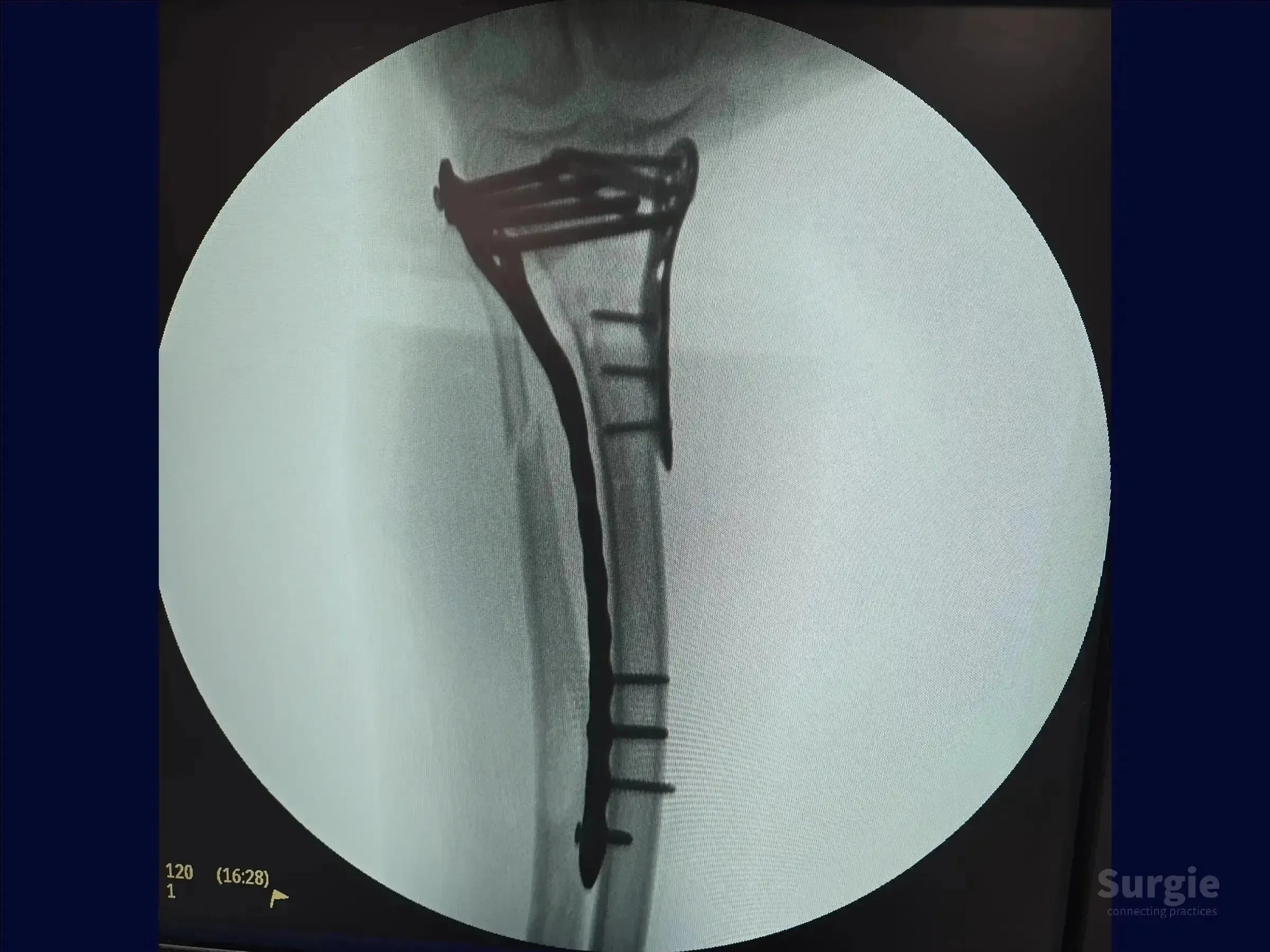 X-ray showing a tibia fracture fixed with a medial anatomical plate and multiple screws for surgical stabilization.