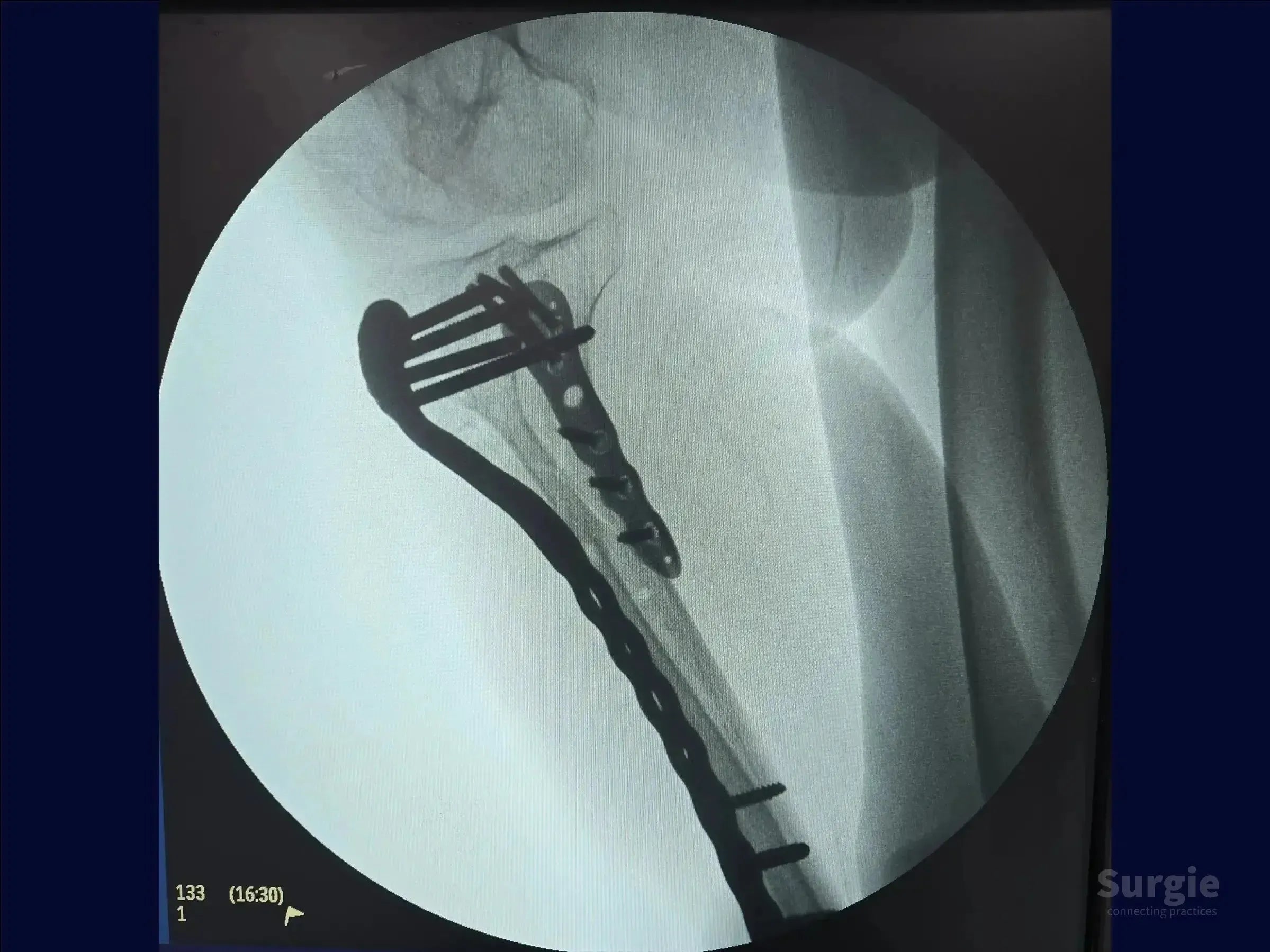 X-ray showing two-column fixation of a tibial fracture with pre-contoured metal plates and screws for anatomical alignment.