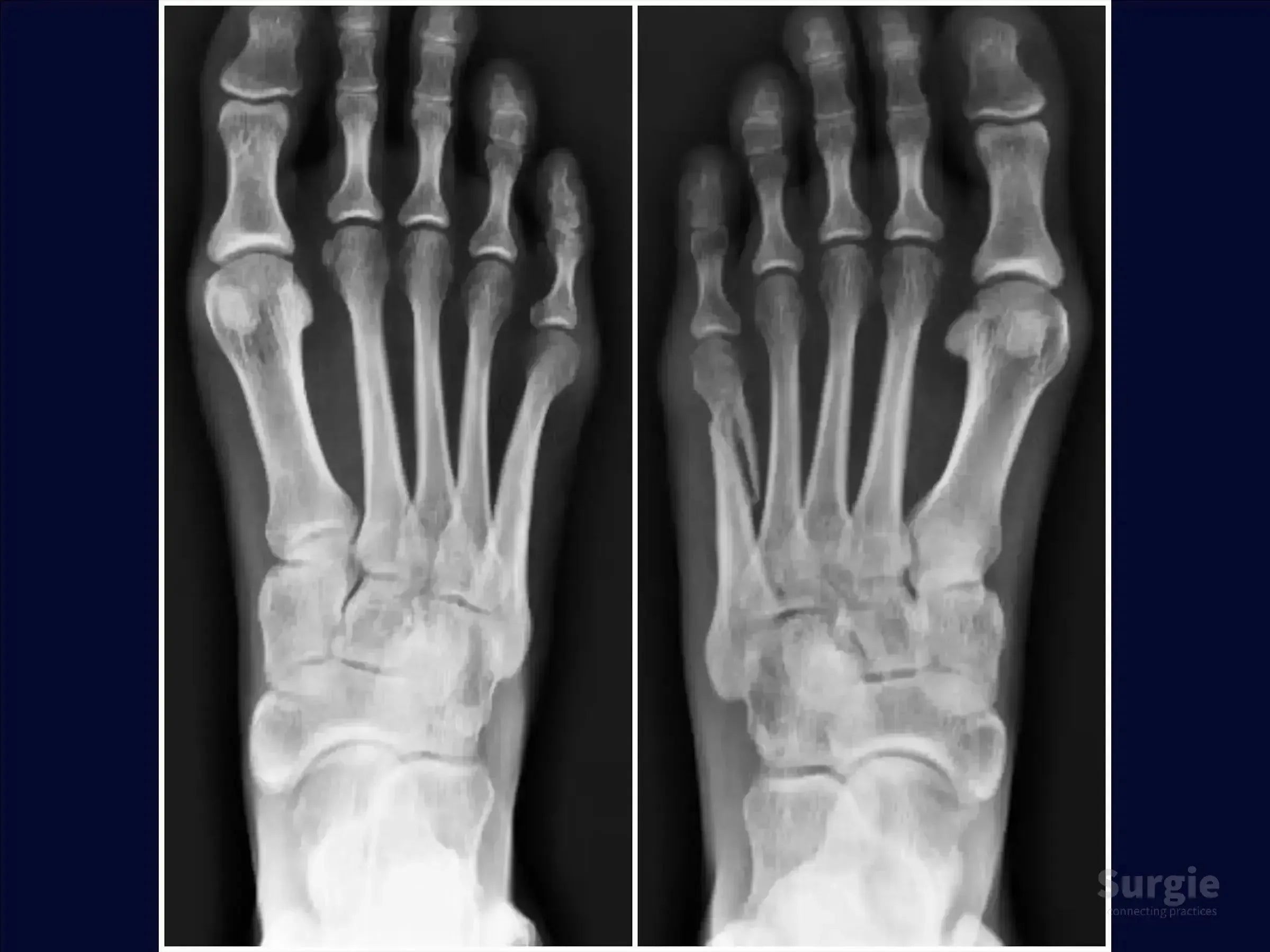 X-ray showing a displaced fifth metatarsal fracture in the foot compared to a healthy foot for surgical assessment.